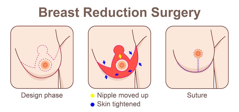 Illustration showing the concept of how breast reduction is performed and what it does to the breast.