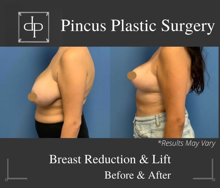Before and after image showing the results of a breast reduction in Smithtown, NY.