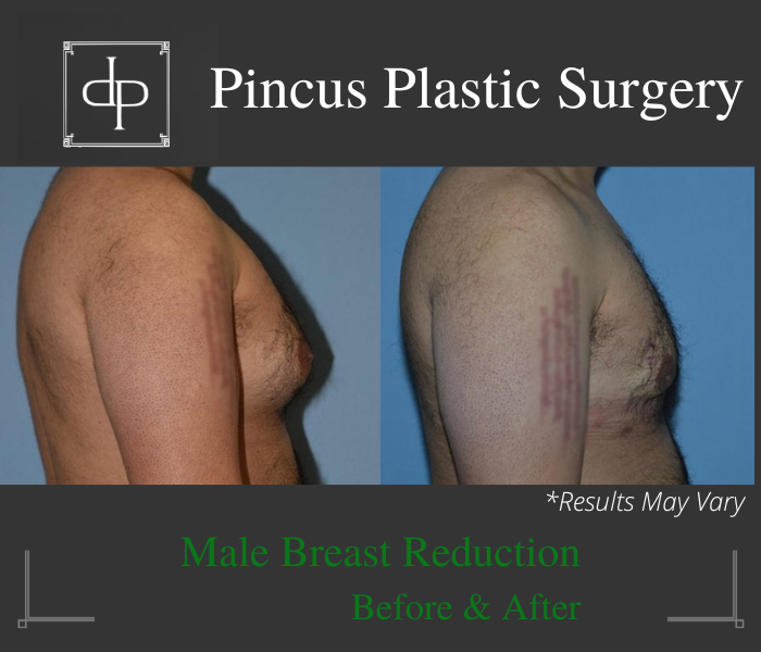 Before and after image showing the results of gynecomastia surgery performed in Smithtown, NY.