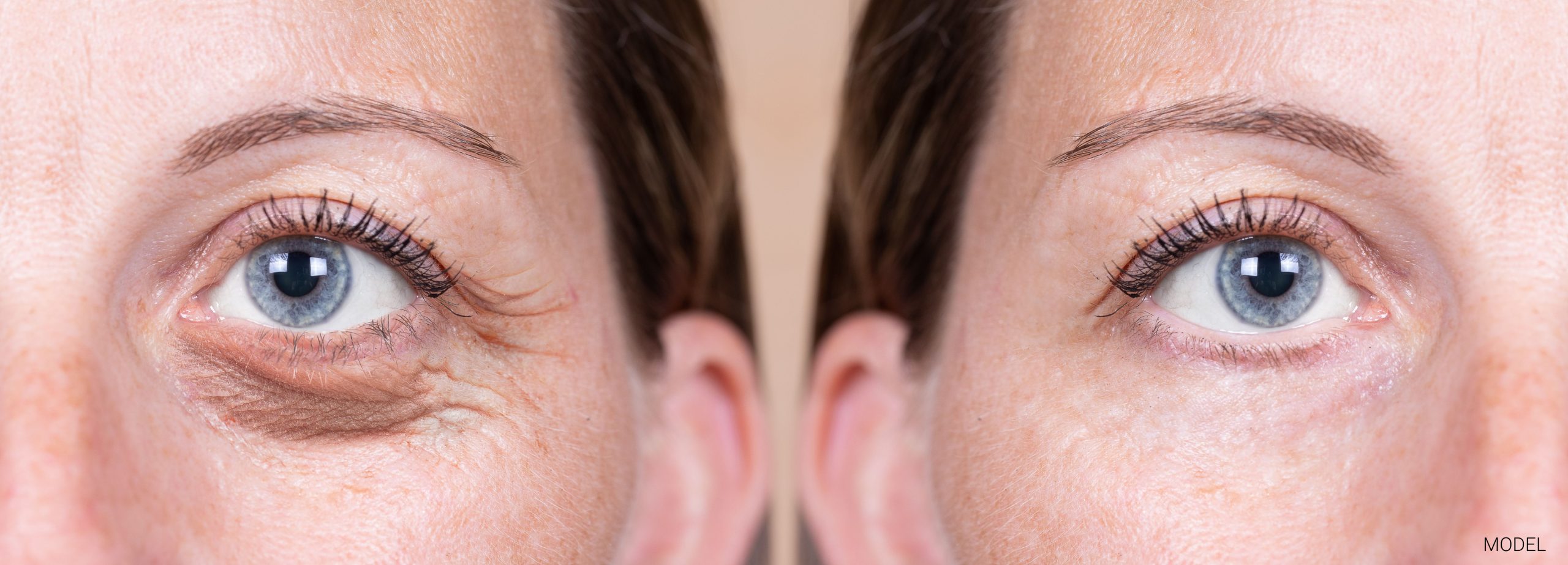Top 5 Reasons to Consider Blepharoplasty This New Year - Pincus Plastic  Surgery