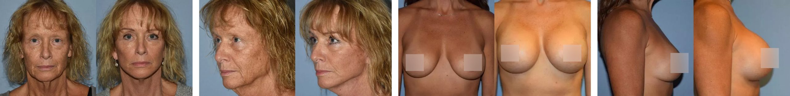 Before & Afters Patient Photos