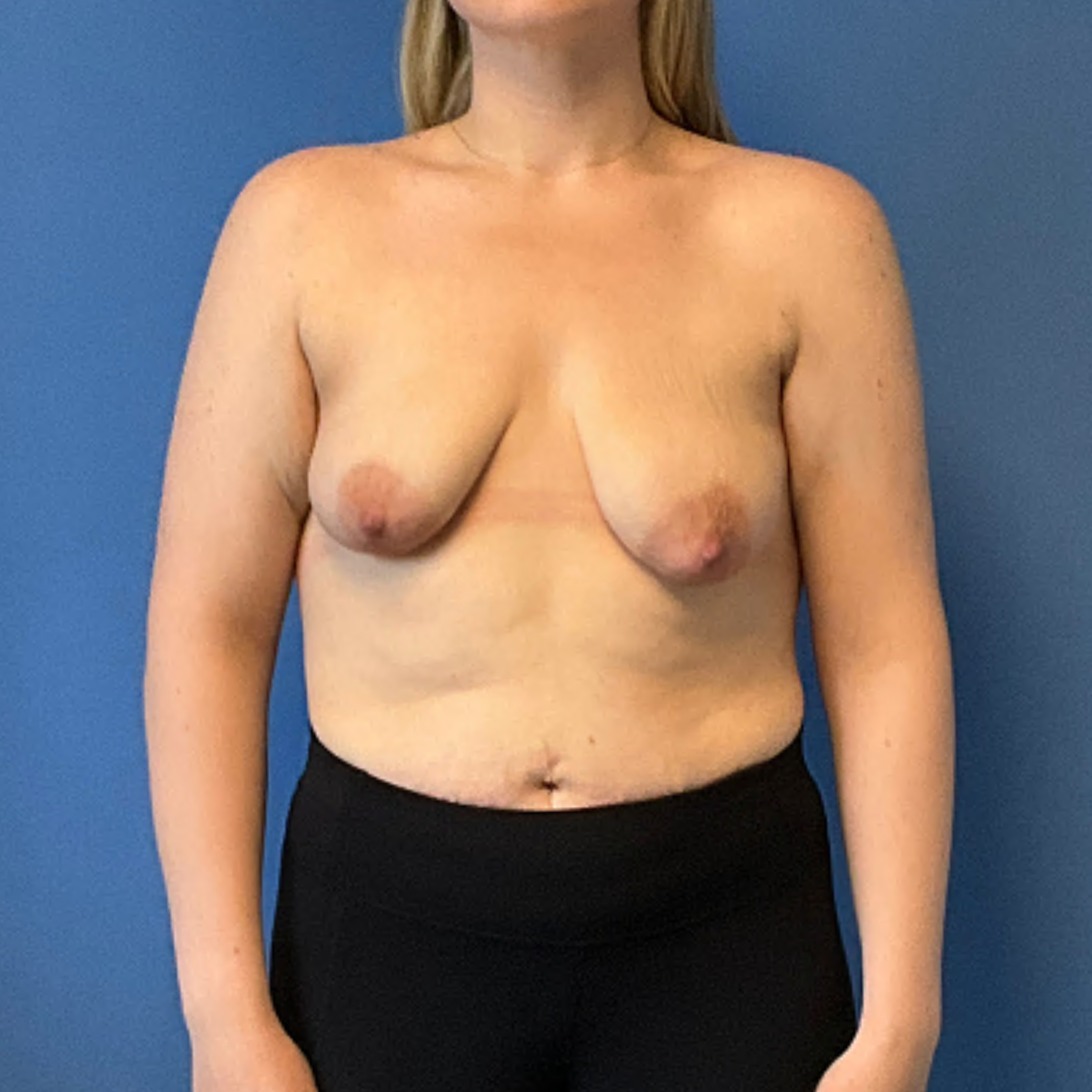 Breast-Augmentation-with-Lift--Case-Study-8307 | Before Breast Lift