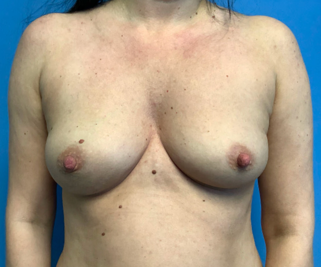 Breast-Augmentation--Case-Study-8612 | Before Breast Augmentation