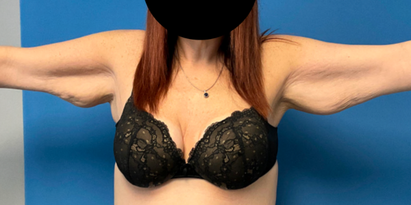 arm-lift--case--2345 | Before Arm Lift