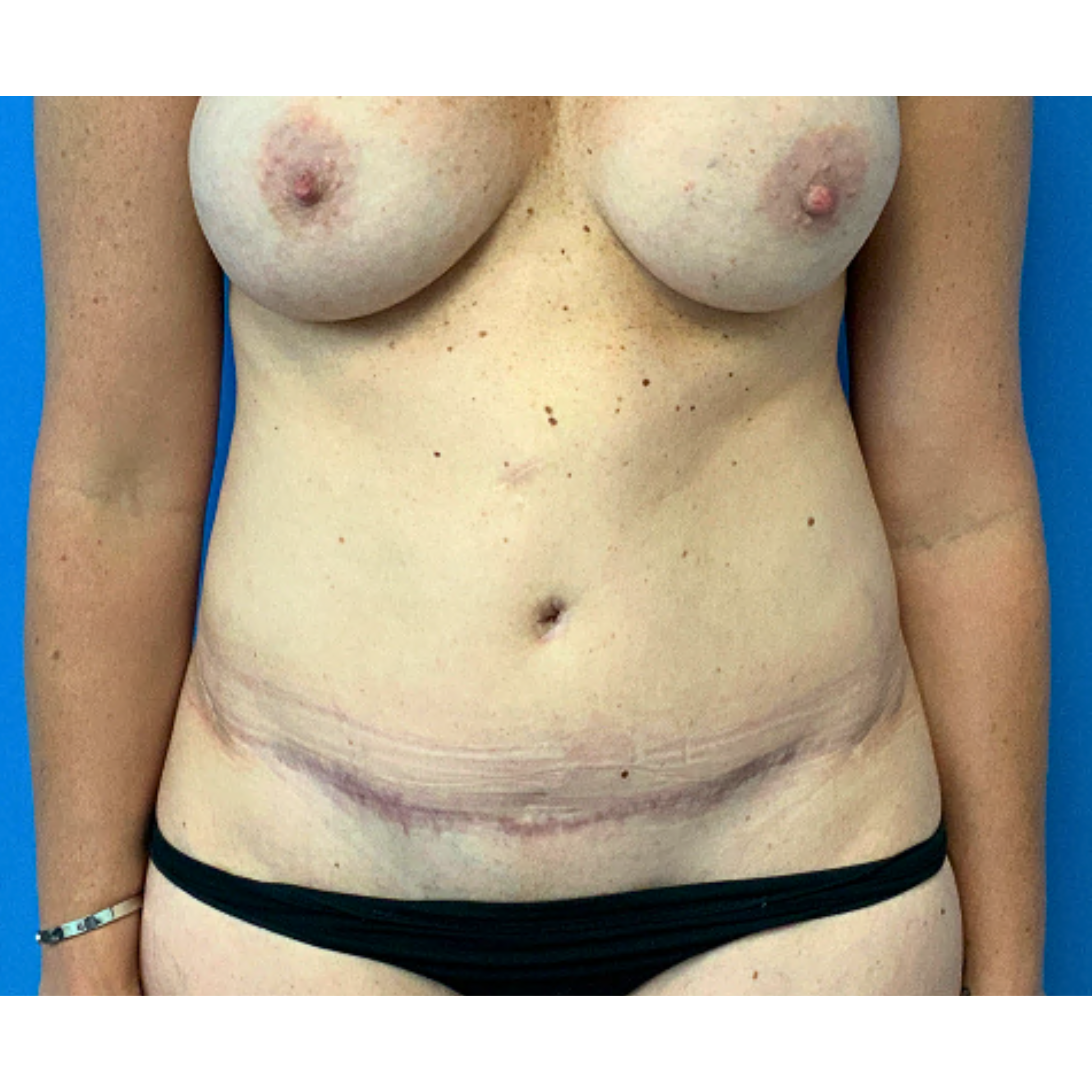 Tummy-Tuck-with-Liposuction--Case-Study-4989 | Before Revision Greatest Hits