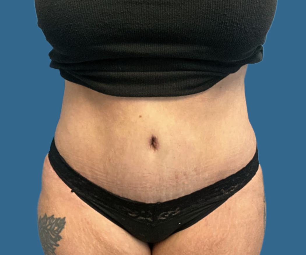 Tummy-Tuck-with-Liposuction--Case-Study-5197 | After Liposuction