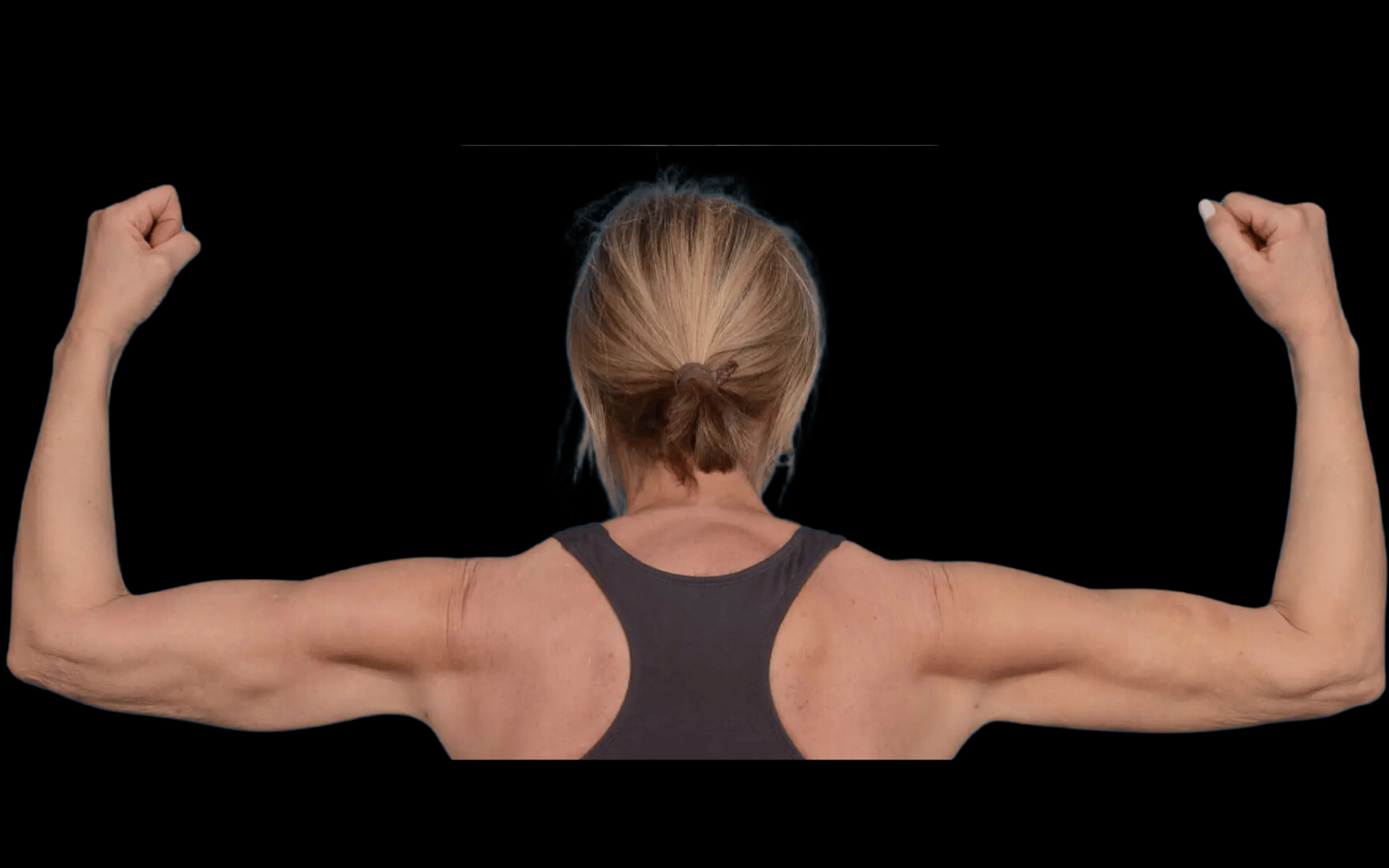 BodyTite--Case-Study-3591 | After BodyTite