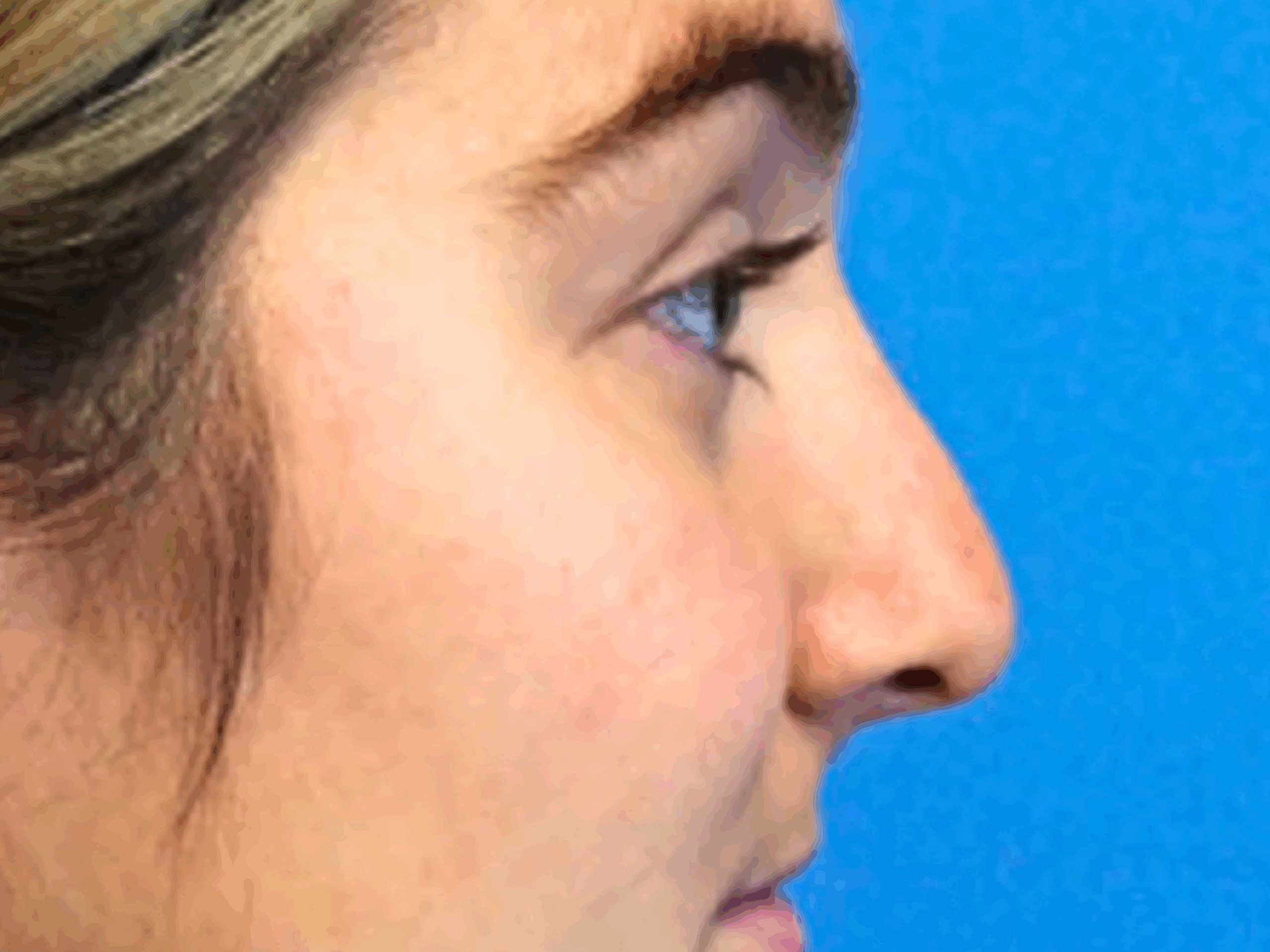 rhinoplasty-case-4567 | Before Rhinoplasty