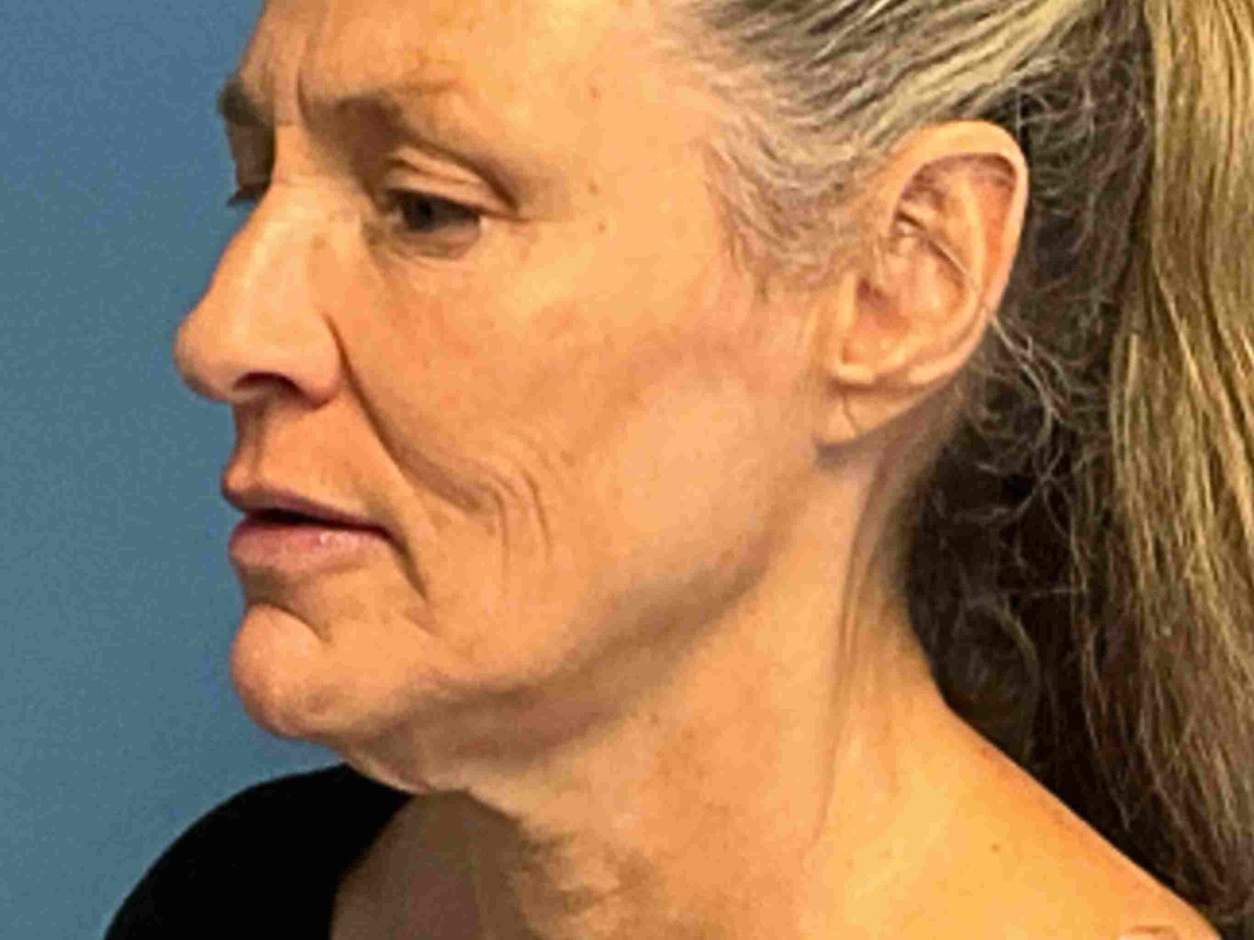 Facelift-Case-4736 | Before Facelift