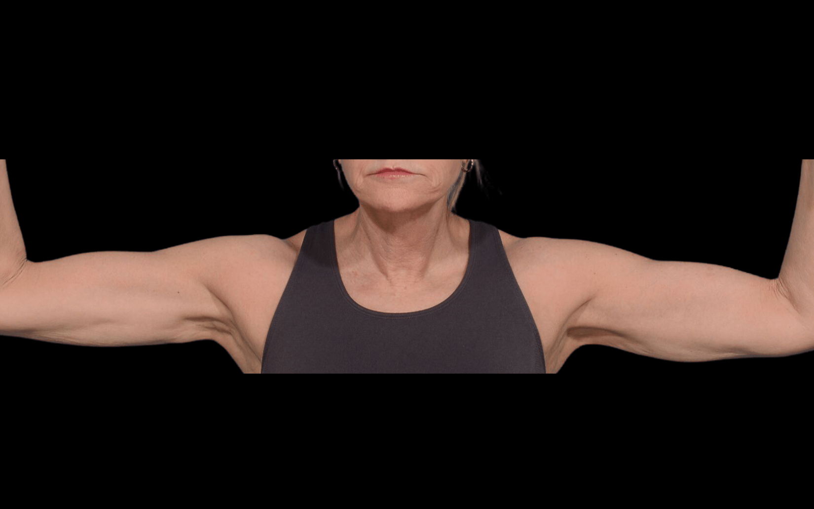 BodyTite--Case-Study-2819 | After BodyTite