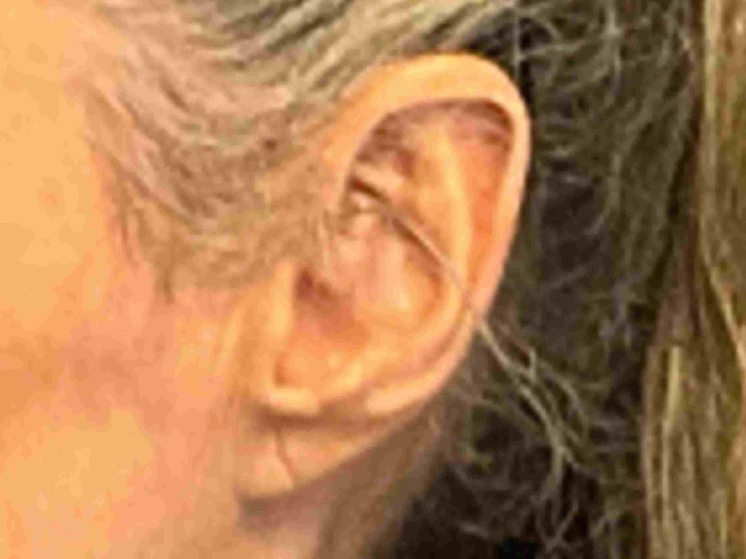 pixie-ear-deformity-case-334 | Before Pixie Ear Repair