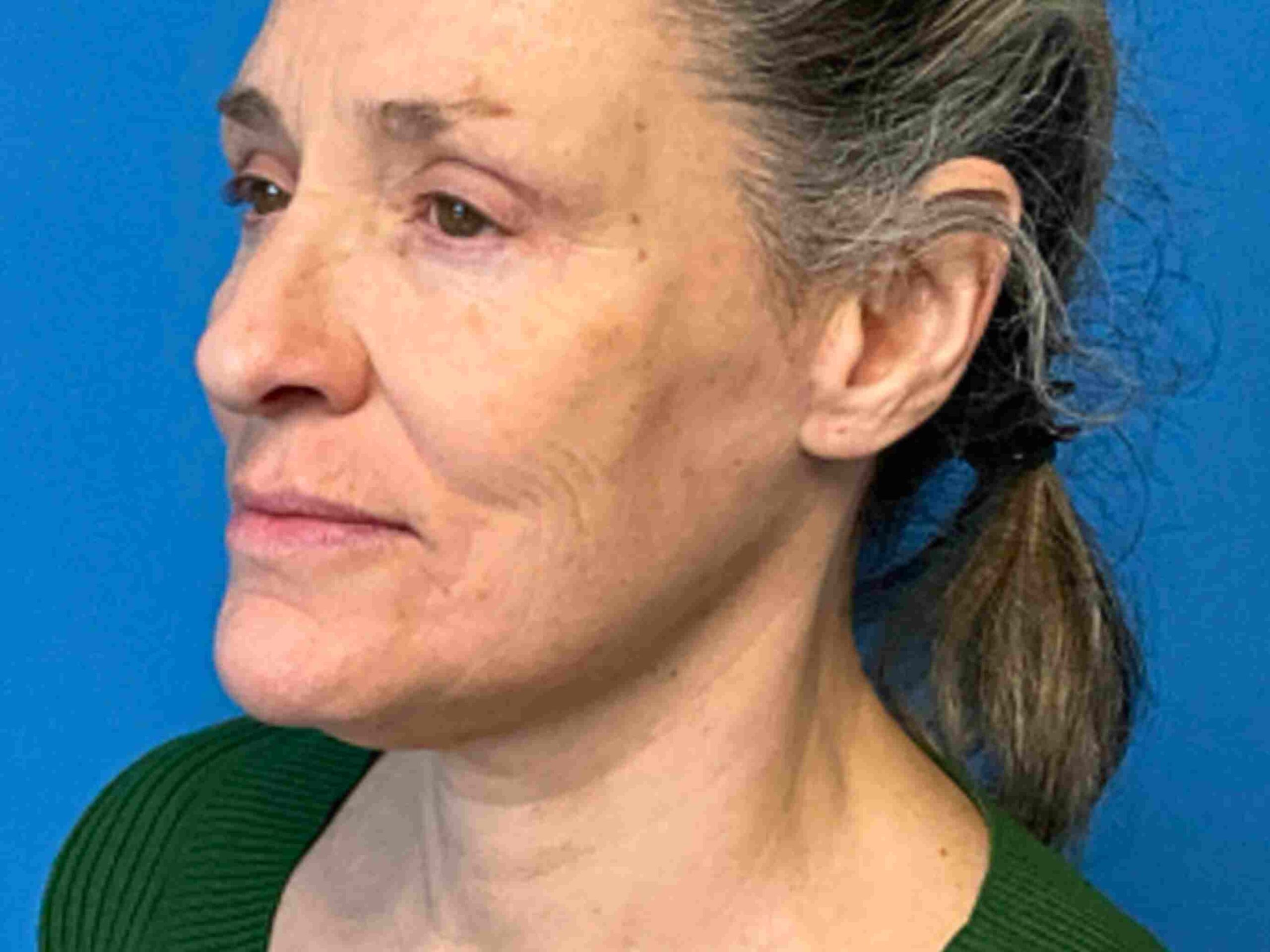 Facelift-Case-4736 | After Facelift