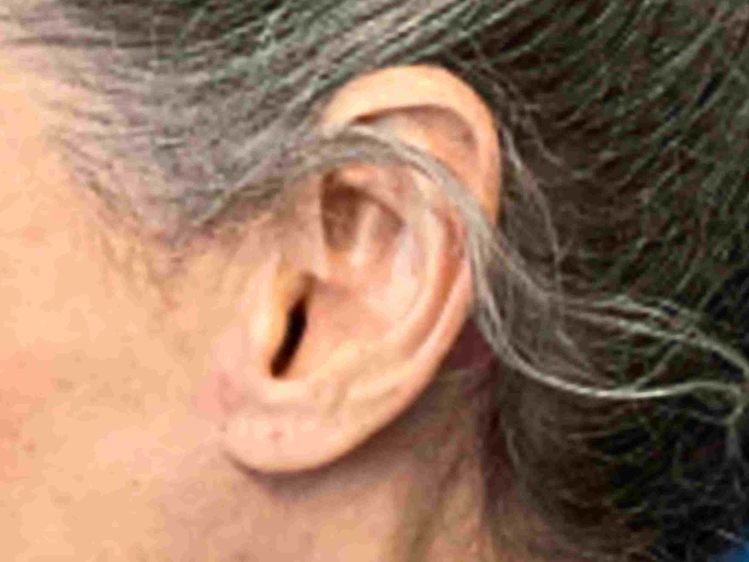 pixie-ear-deformity-case-334 | After Pixie Ear Repair