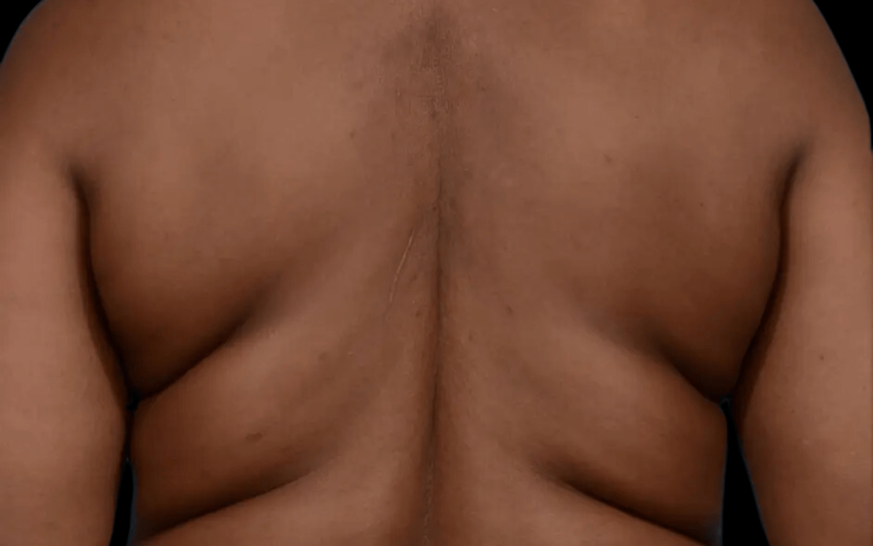 BodyTite--Case-Study-9374 | Before BodyTite