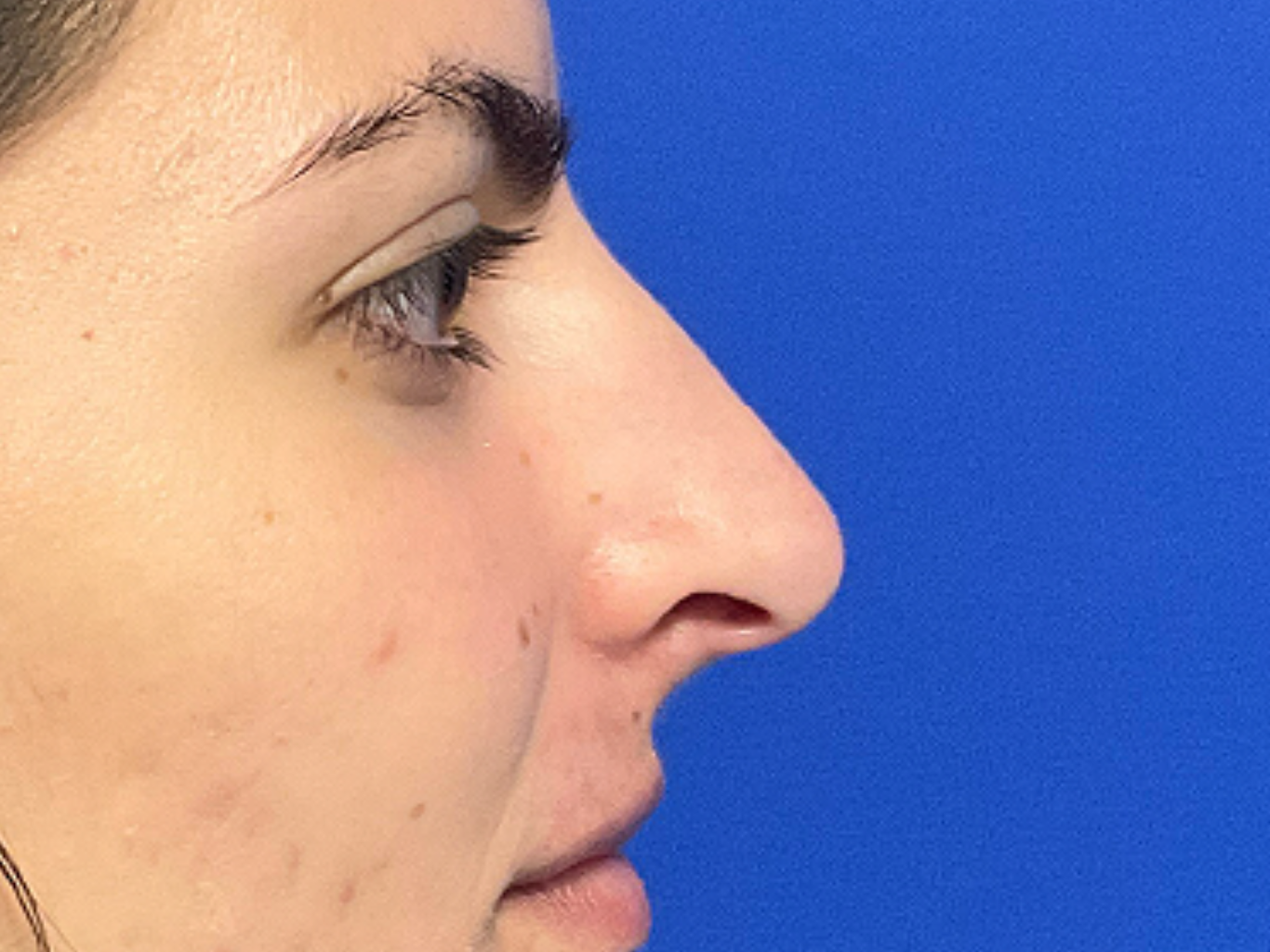 Rhinoplasty-case--321 | Before Rhinoplasty
