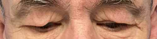 blepharoplasty-case--3337 | Before Blepharoplasty