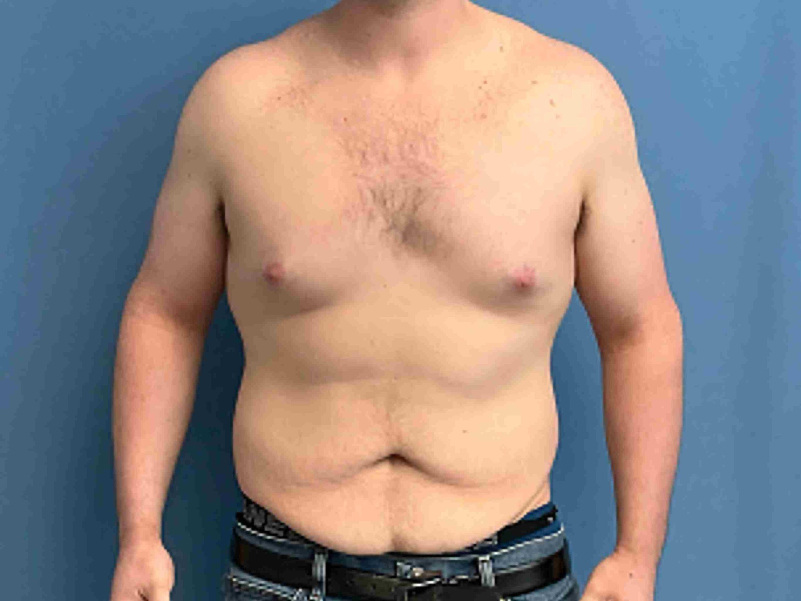 Panniculectomy-case--2876 | Before Body