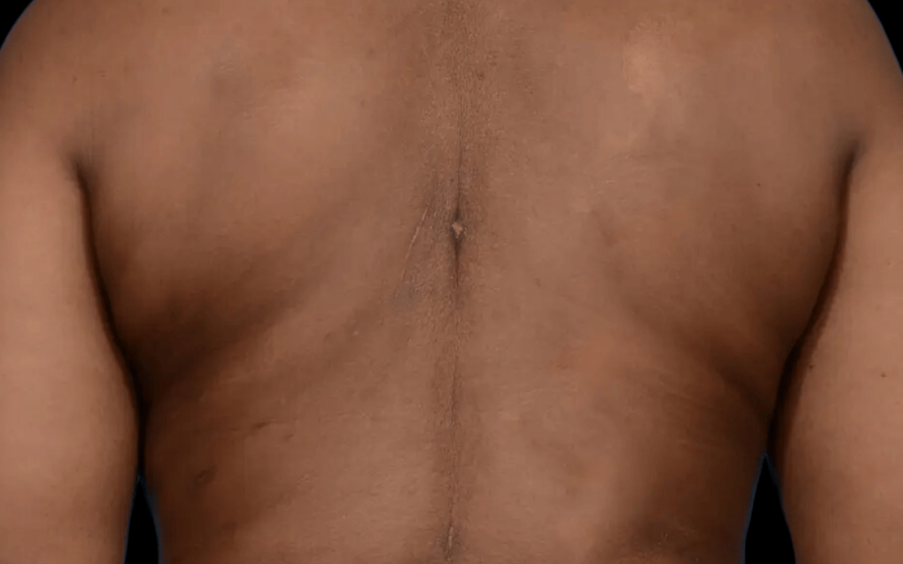 BodyTite--Case-Study-9374 | After BodyTite