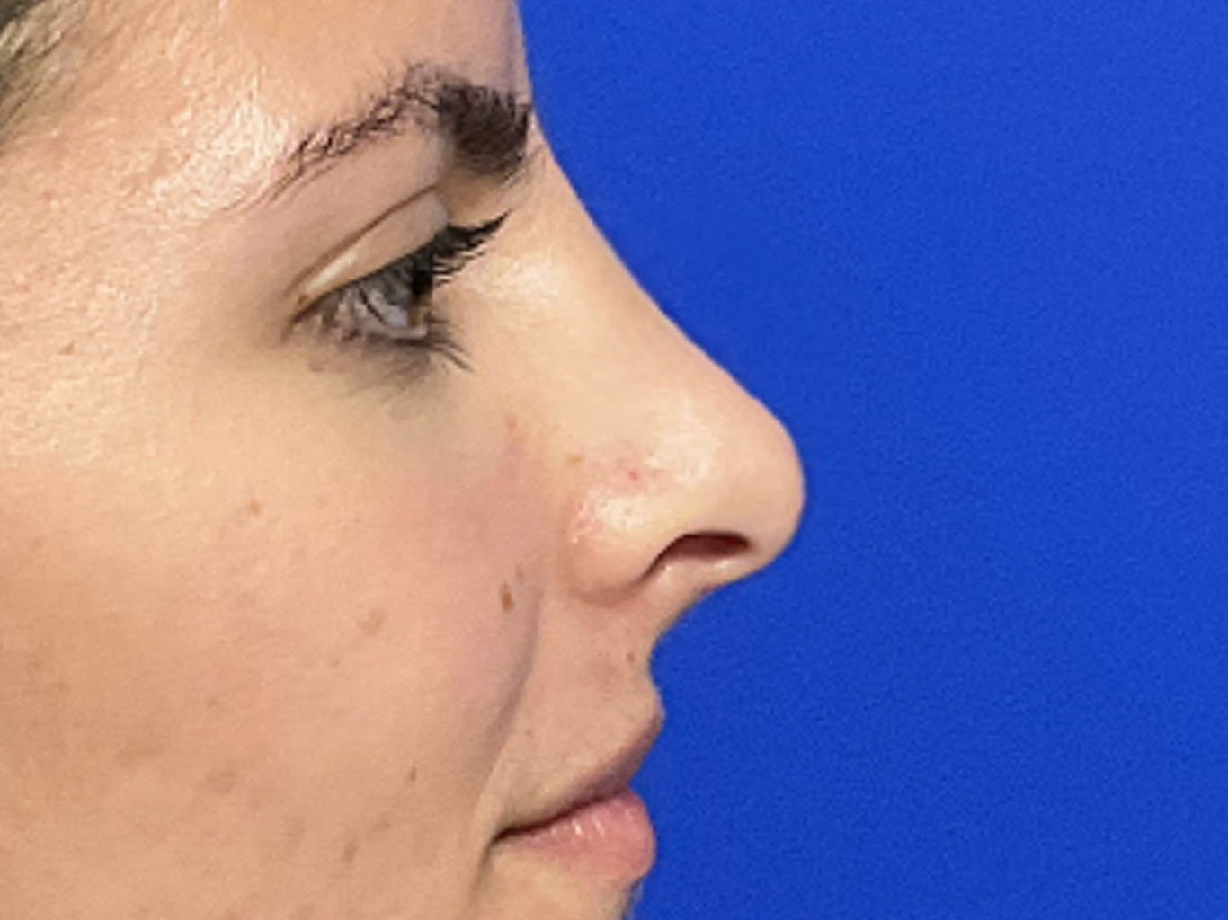 Rhinoplasty-case--321 | After Rhinoplasty