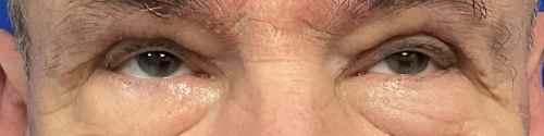 blepharoplasty-case--3337 | After Blepharoplasty