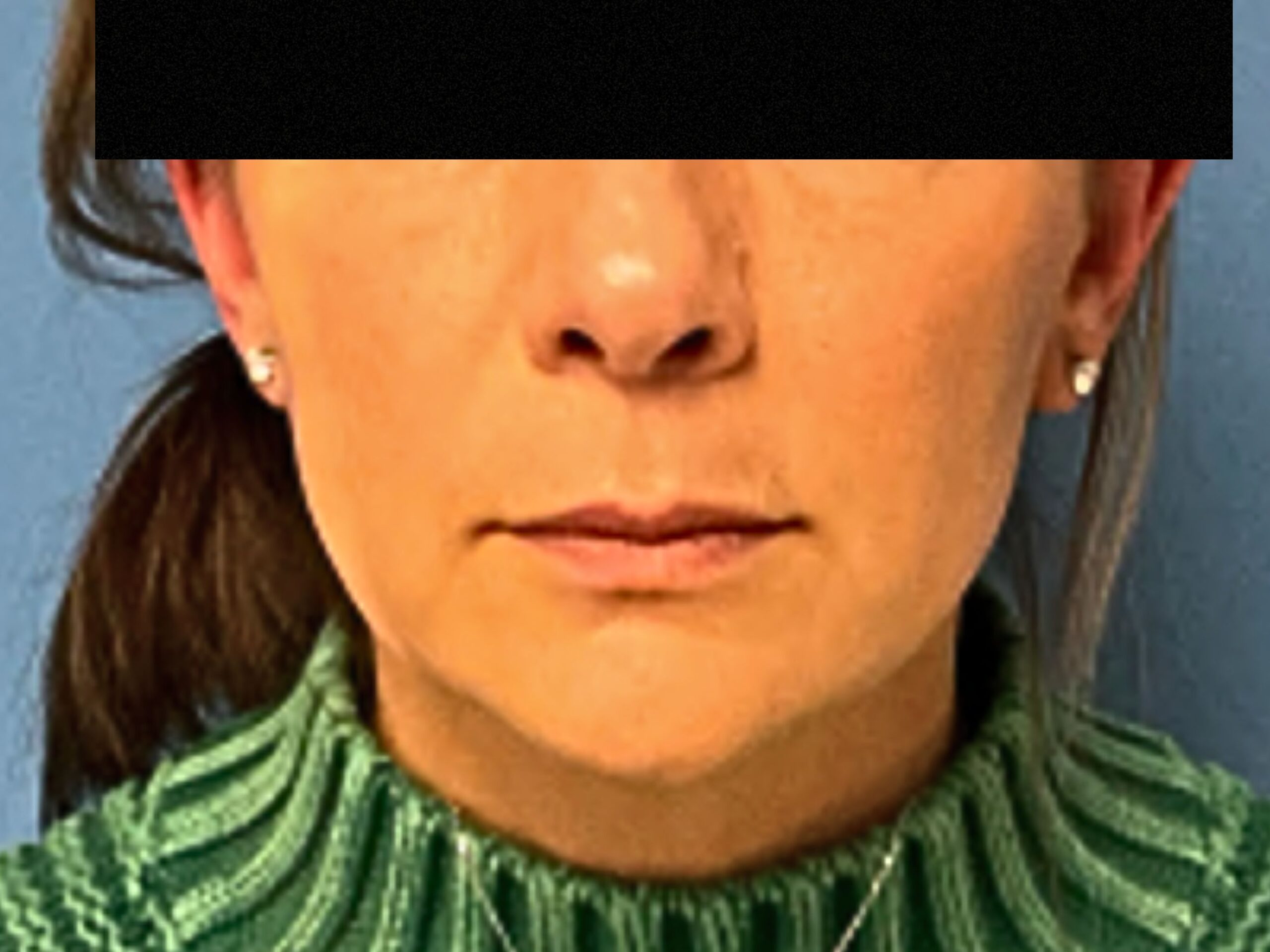 case--7676 | Before FaceTite