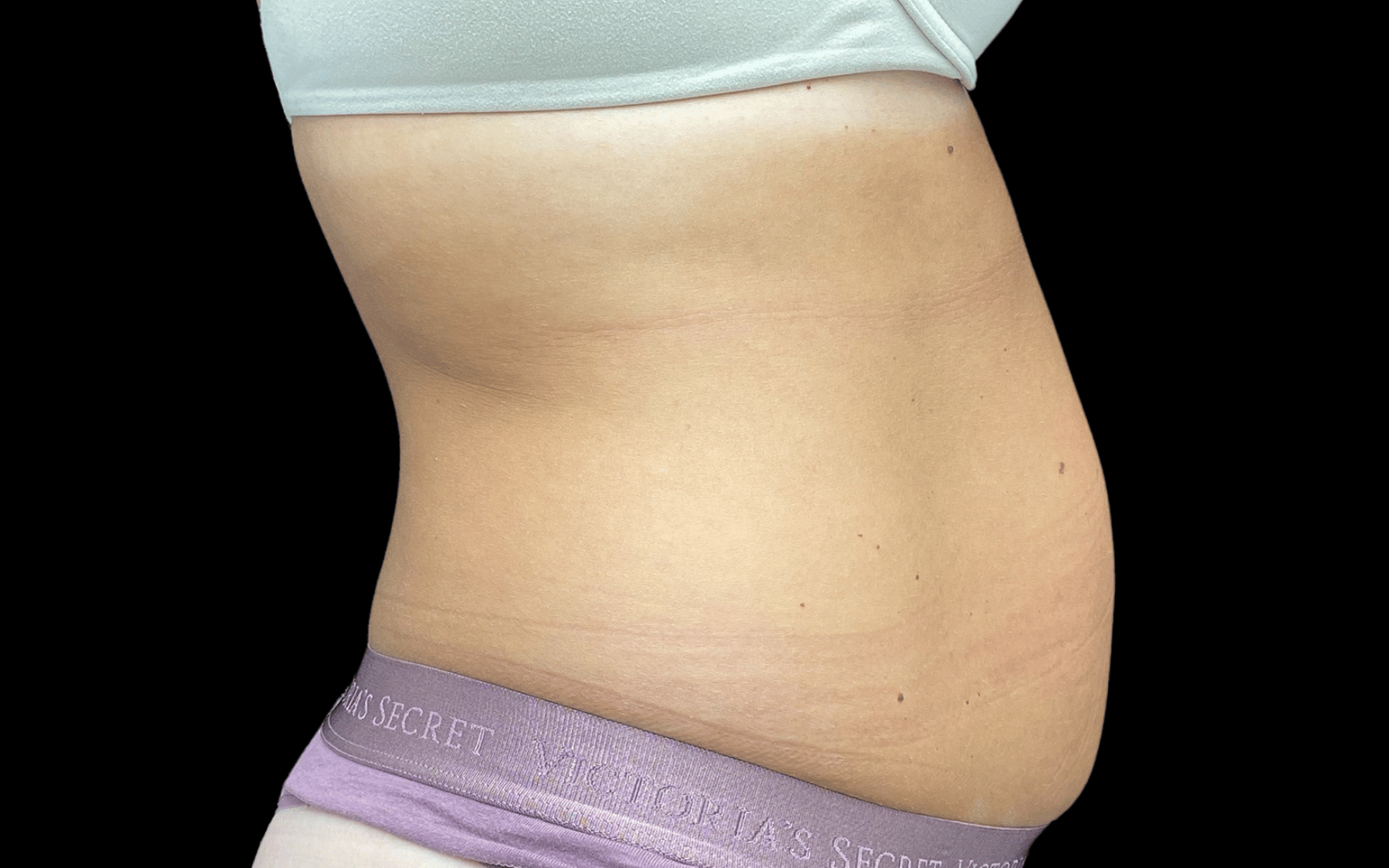 BodyTite--Case-Study-5208 | Before BodyTite