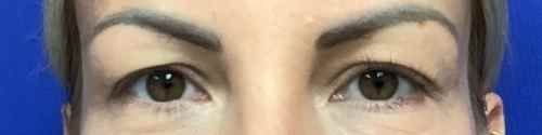 blepharoplasty-case--4455 | Before Blepharoplasty