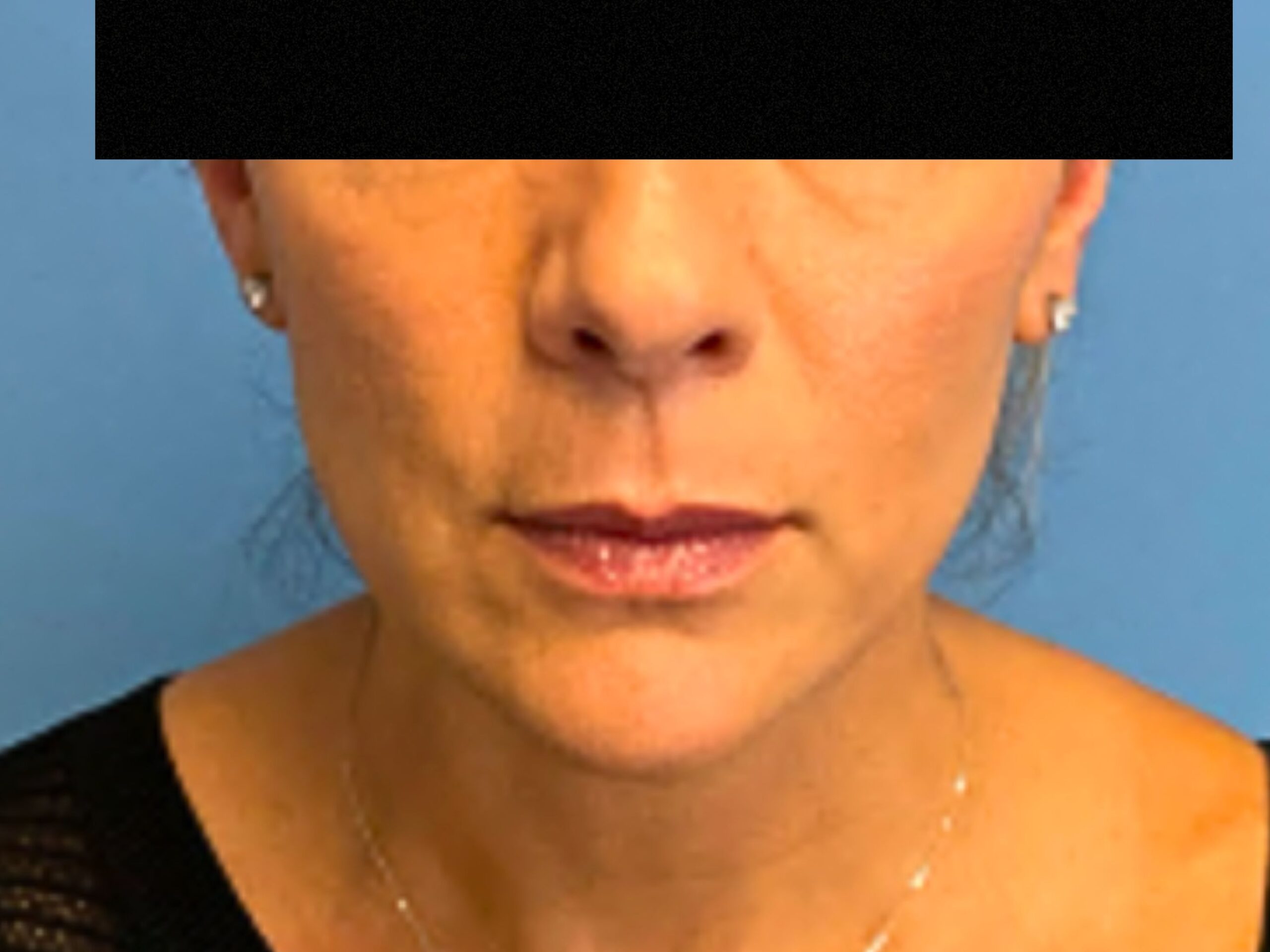 case--7676 | After FaceTite