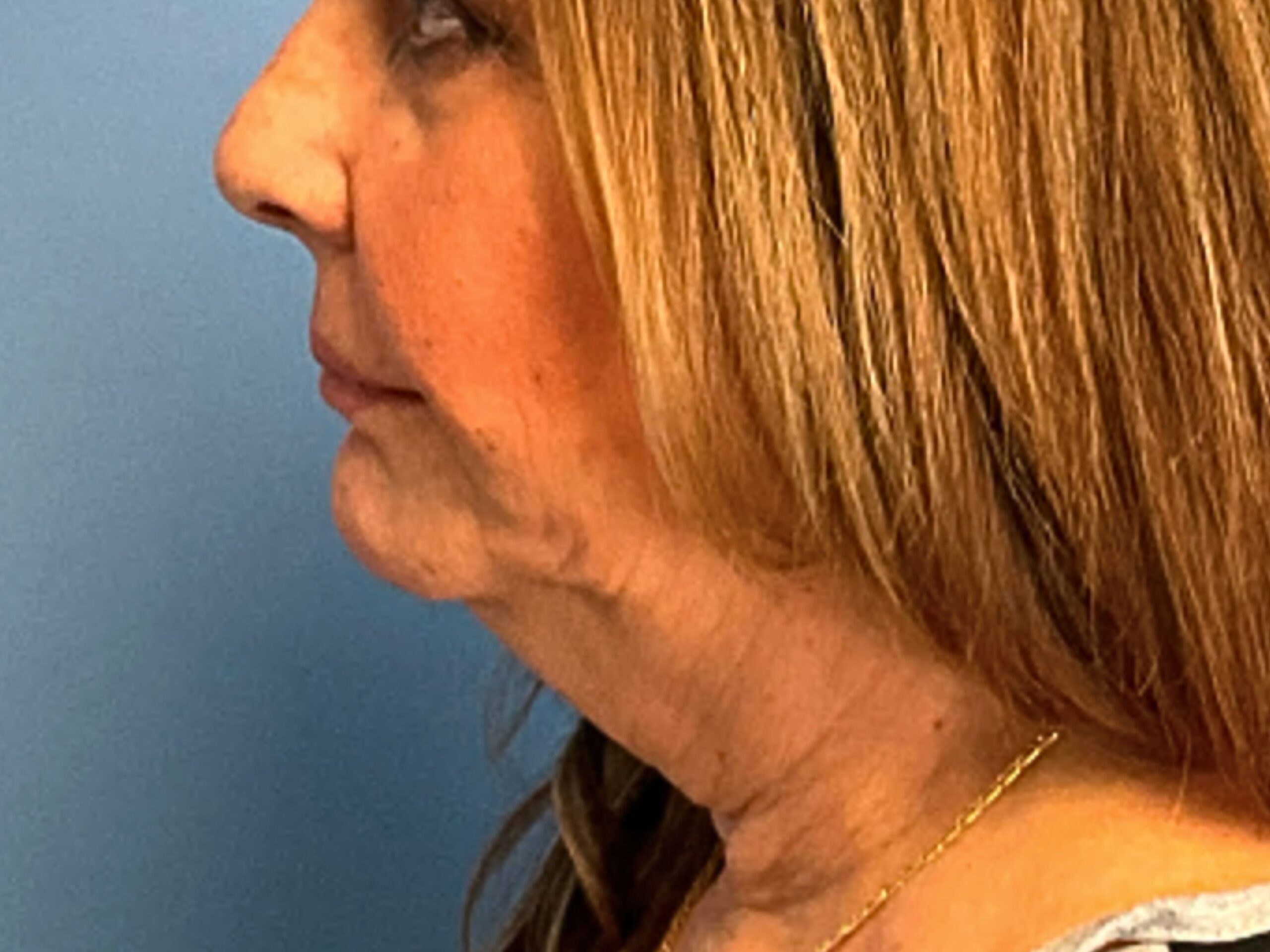 case--3333 | Before Facelift