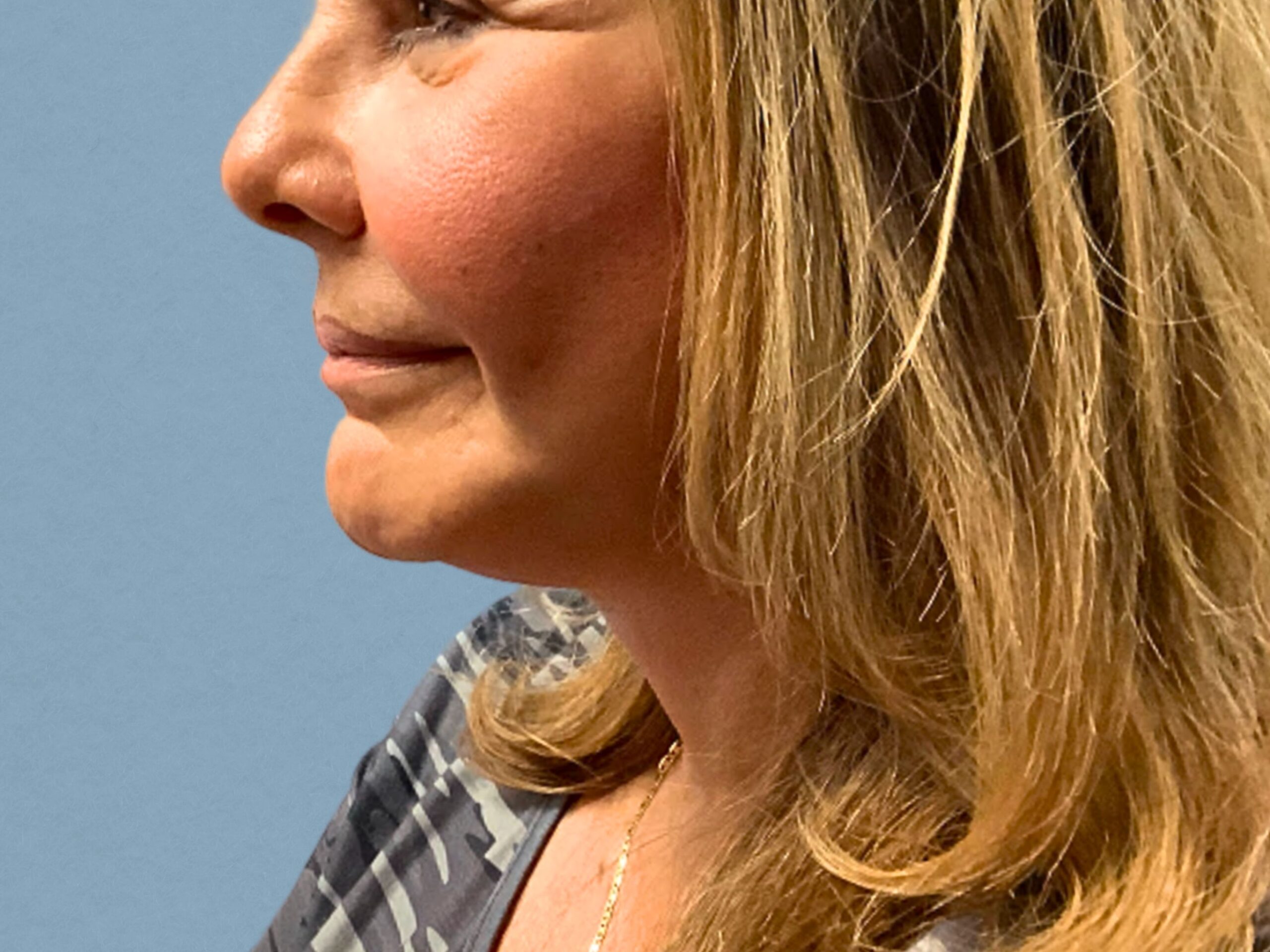 case--3333 | After Facelift