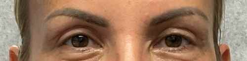 blepharoplasty-case--4455 | After Blepharoplasty