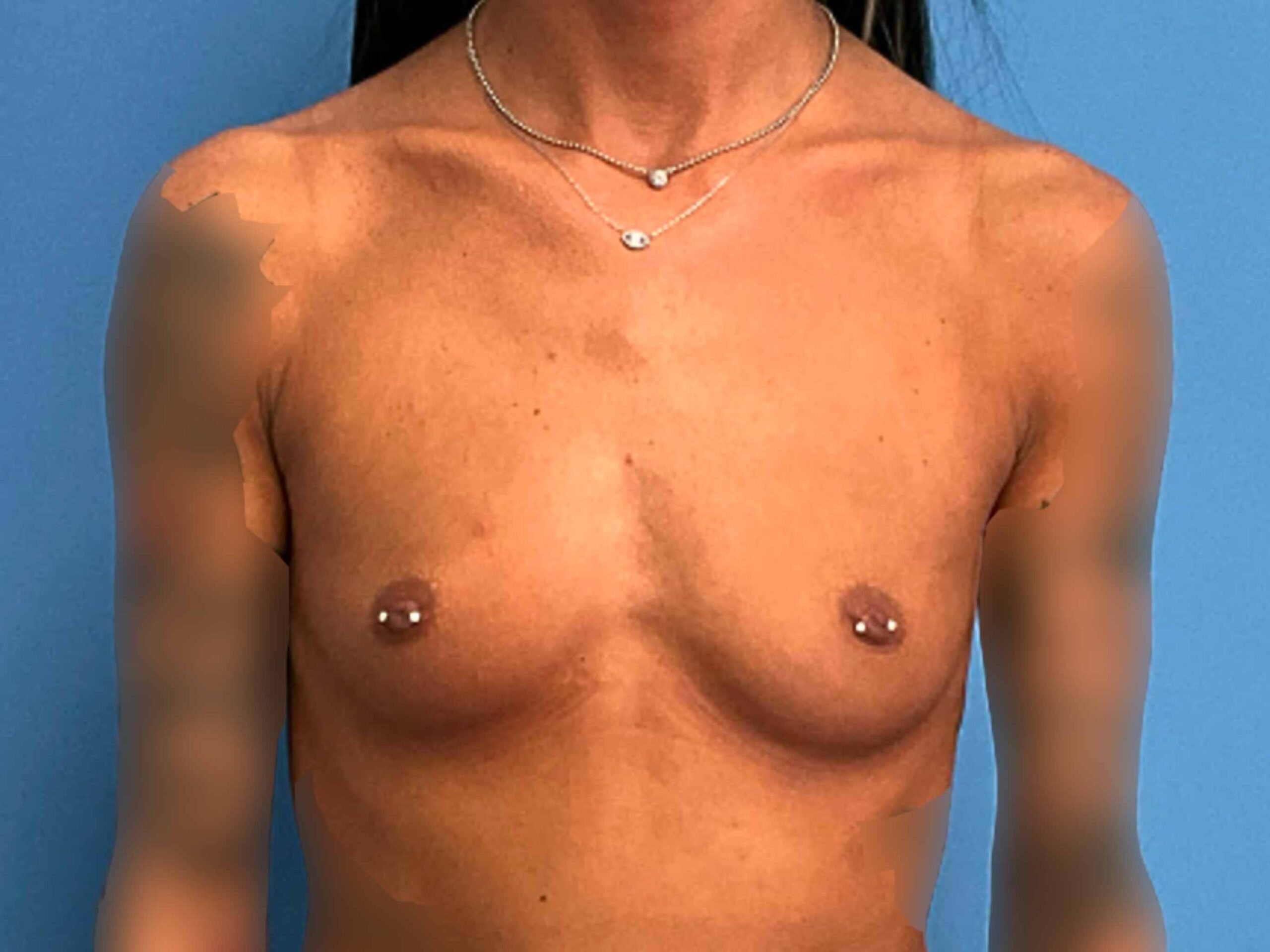 case--7583 | Before Breast Augmentation