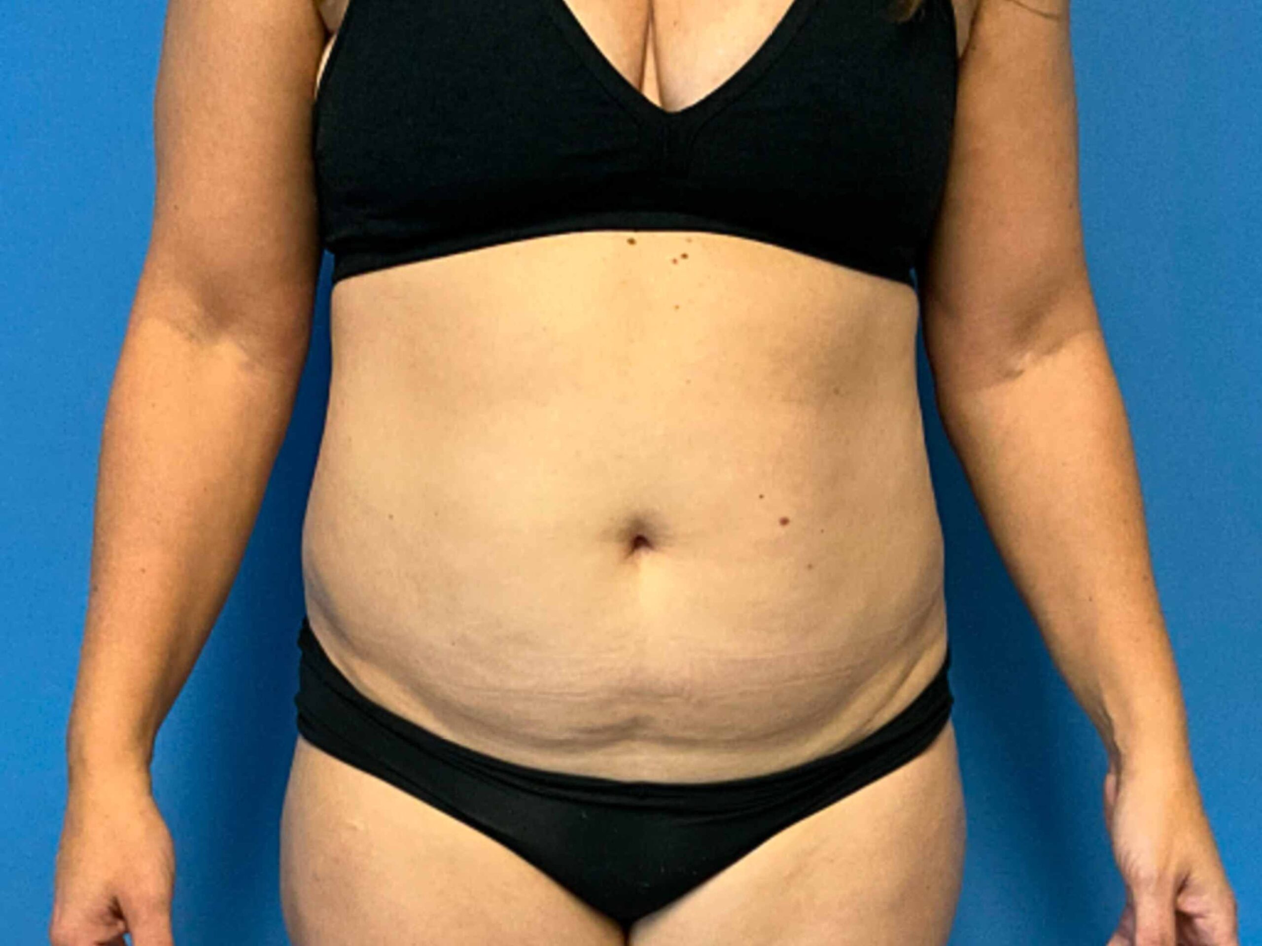 case--4256 | Before BodyTite