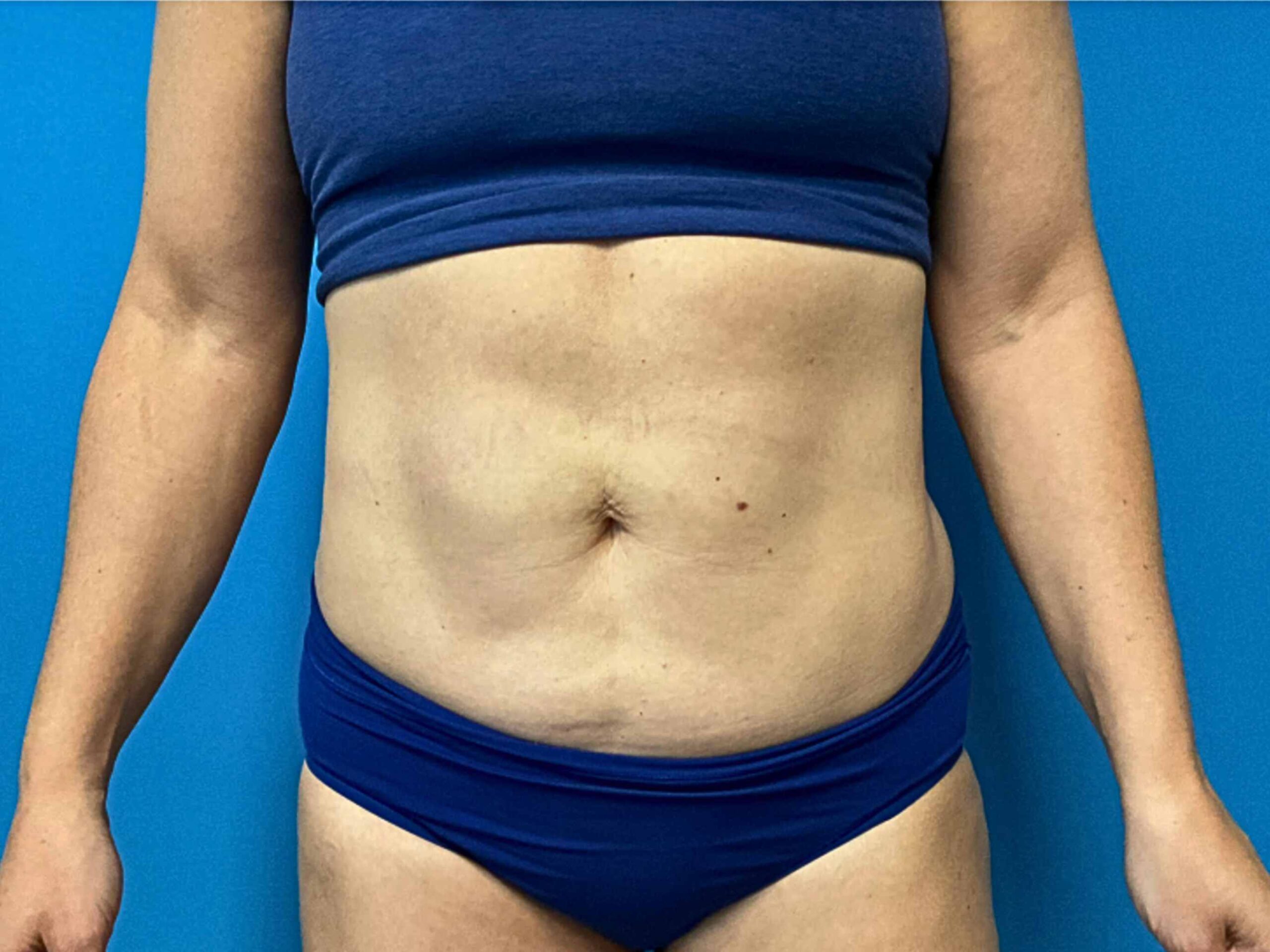 case--4256 | After BodyTite