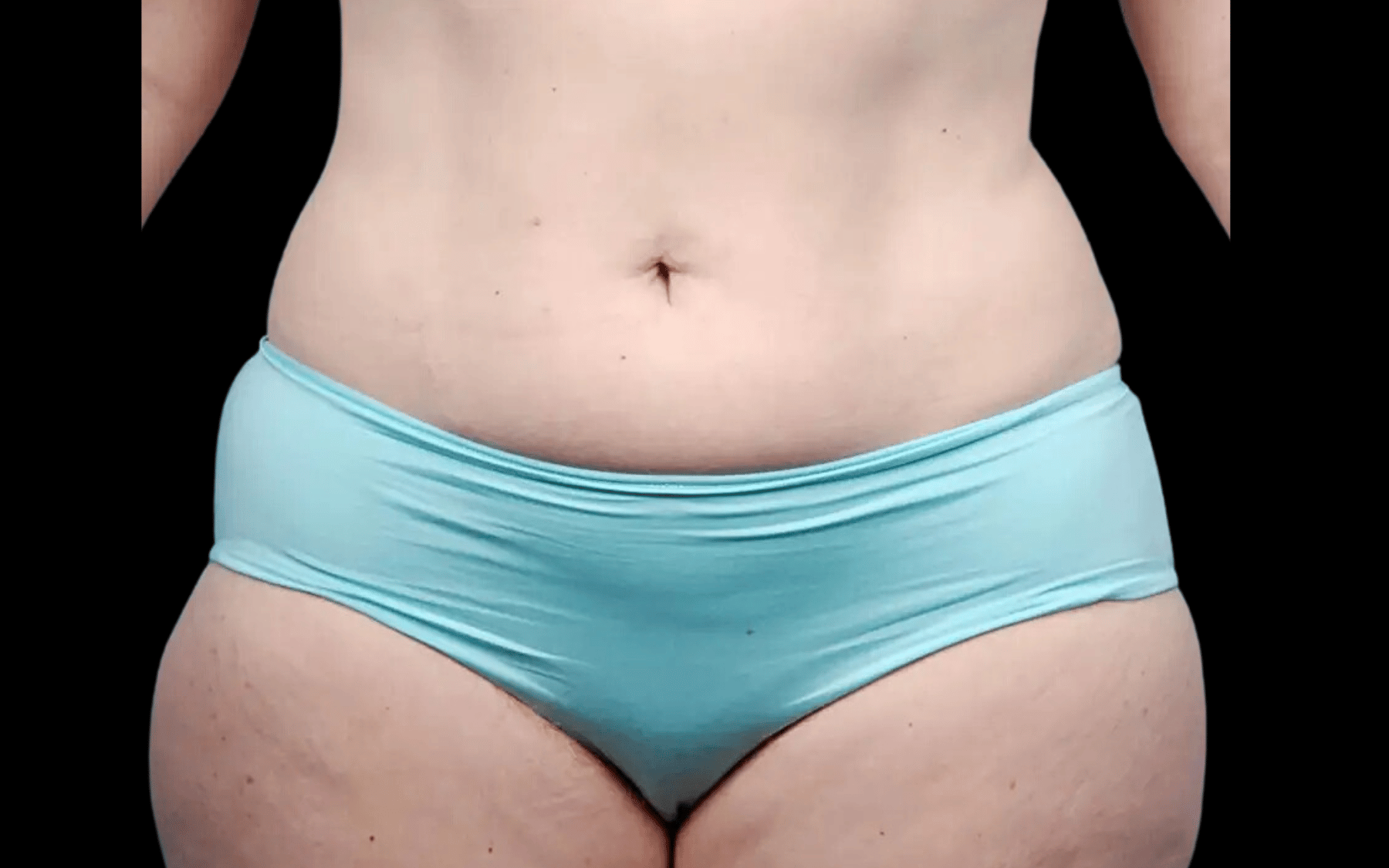 BodyTite--Case-Study-8412 | Before BodyTite