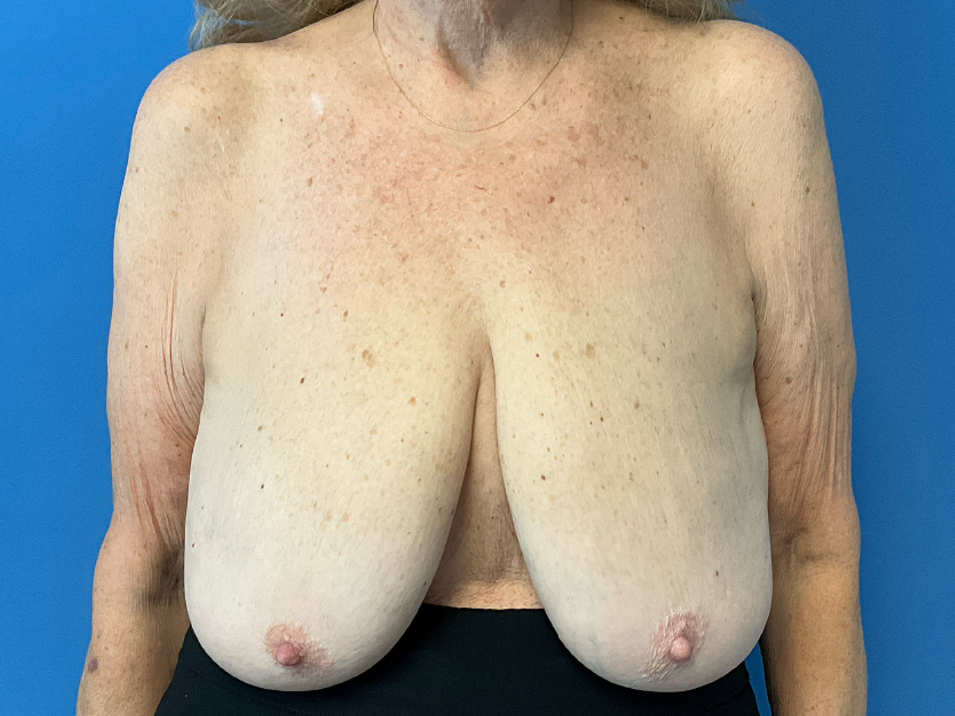 Breast-reduction-case--4894 | Before Breast