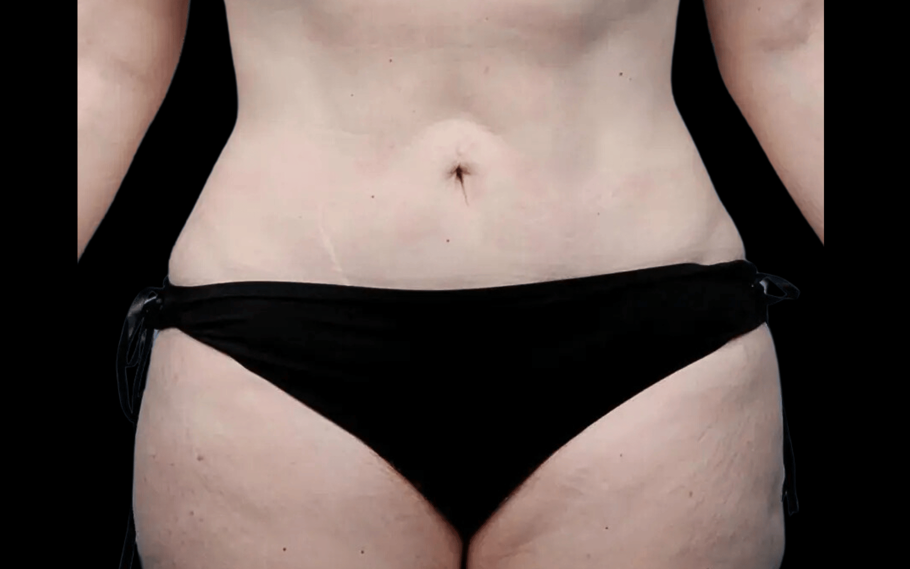 BodyTite--Case-Study-8412 | After BodyTite