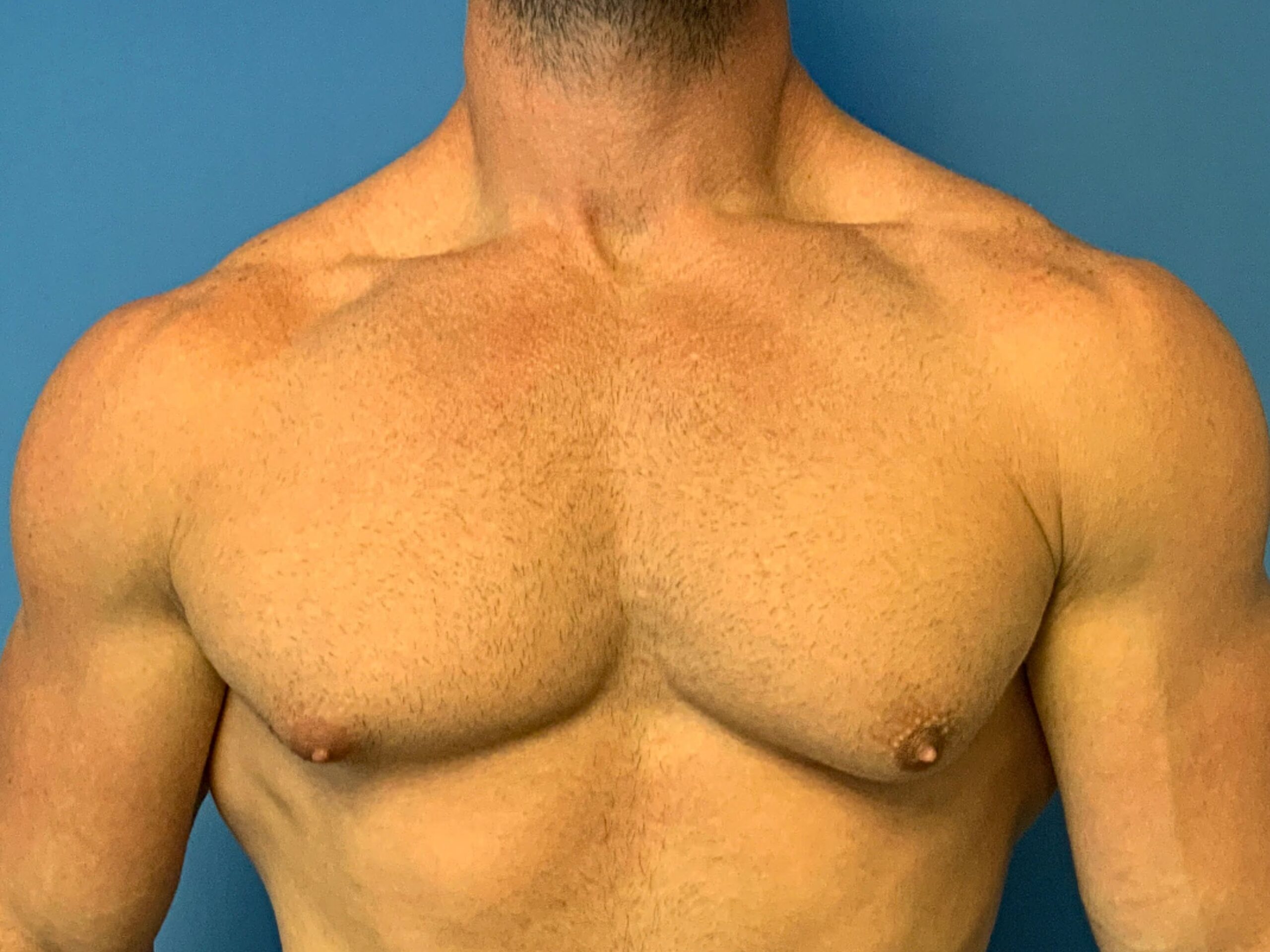 gynecomastia-patient--4856 | Before Breast