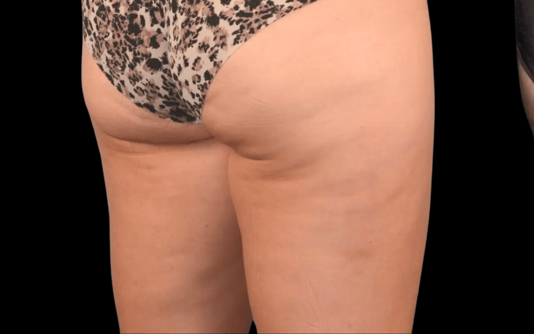 BodyTite--Case-Study-2639 | Before BodyTite