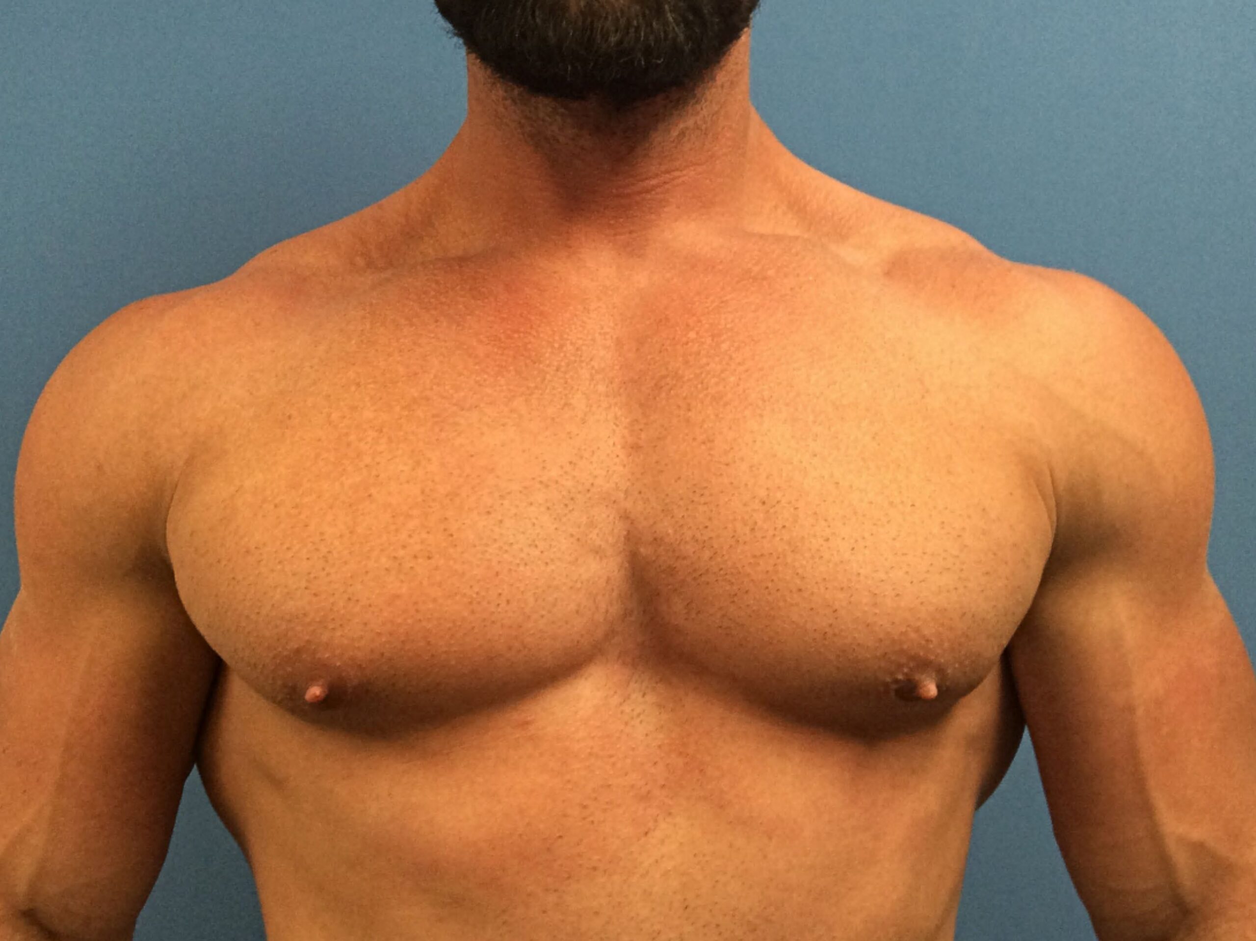 gynecomastia-patient--4856 | After Breast