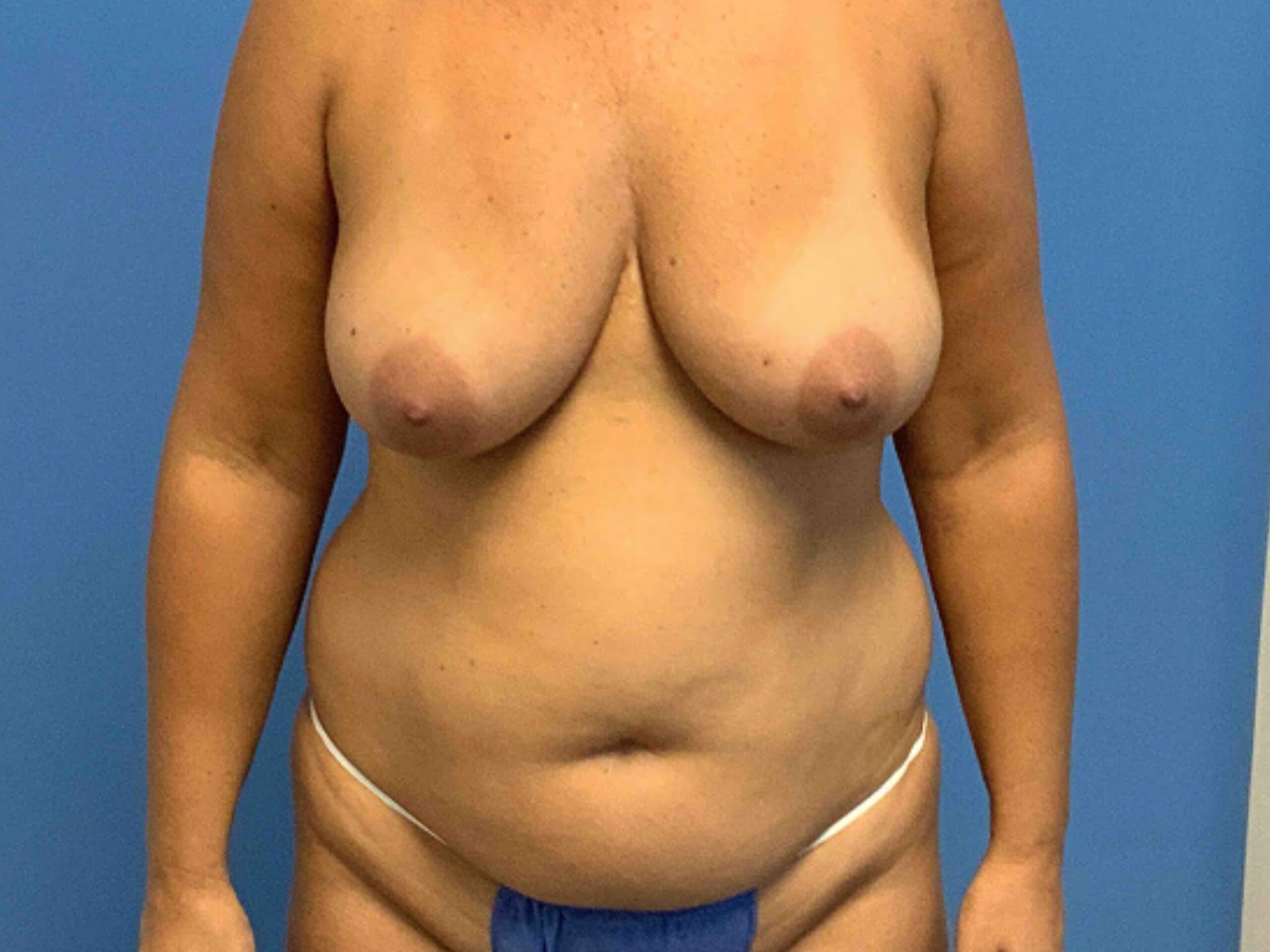 mommy-makeover-patient--3465 | Before Breast Lift