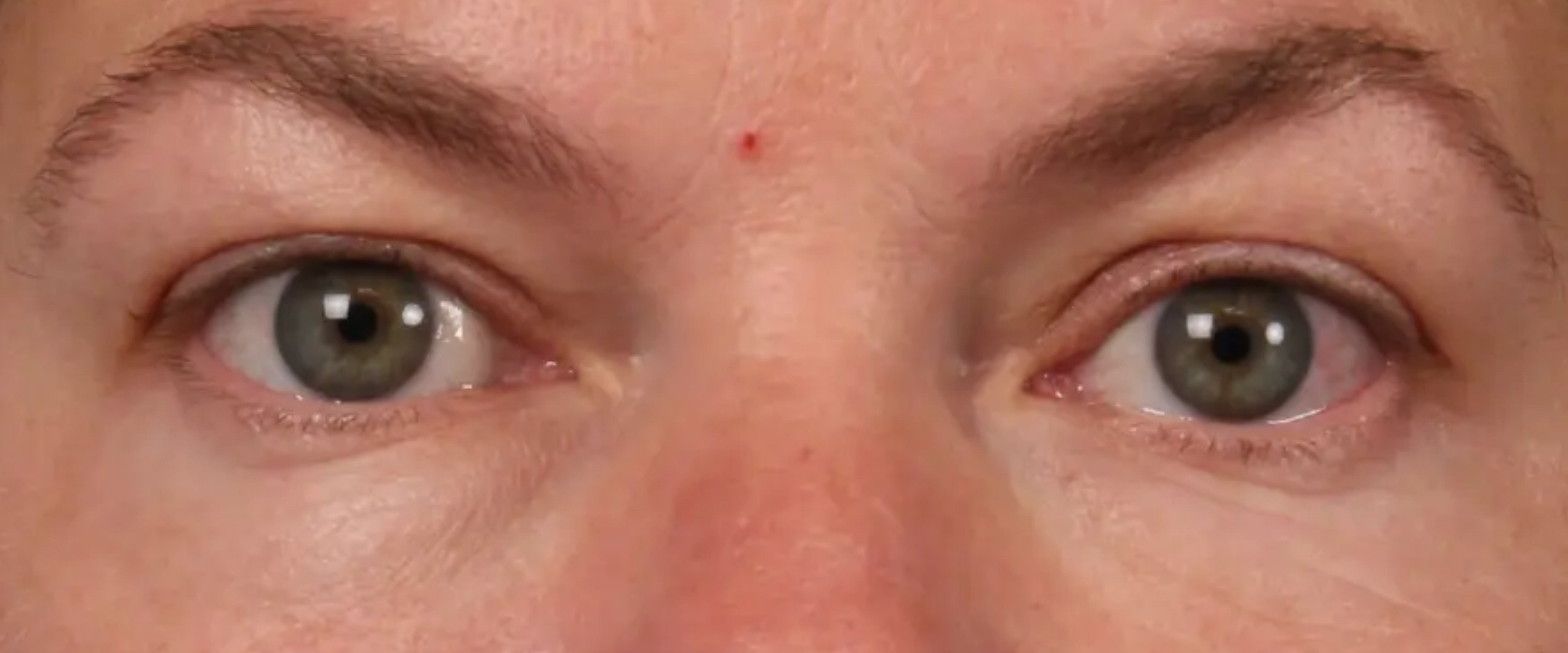 FaceTite--amp--AccuTite--Case-Study-9264 | After Face