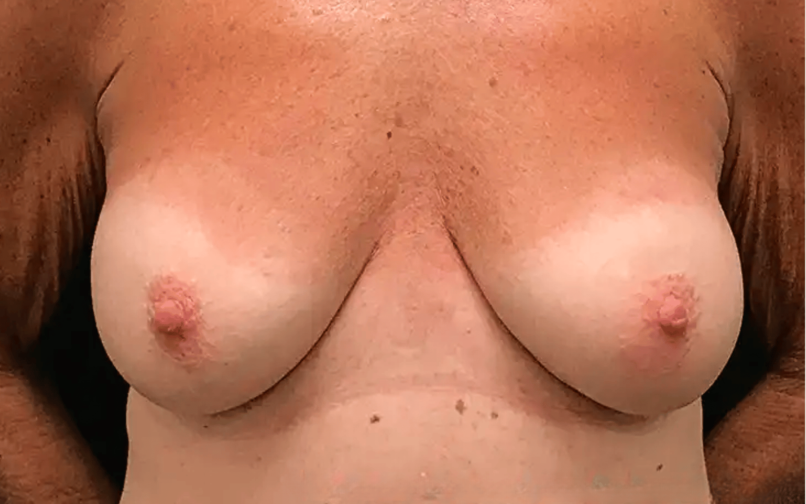 BodyTite--Case-Study-1846 | After BodyTite