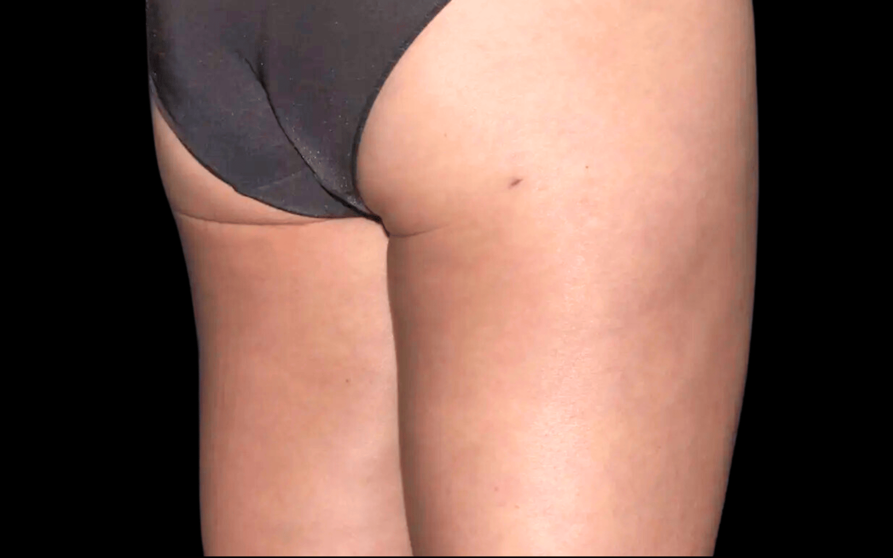 BodyTite--Case-Study-2639 | After BodyTite