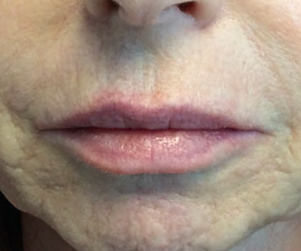 Lip-Filler--Case-Study-6872 | Before Face