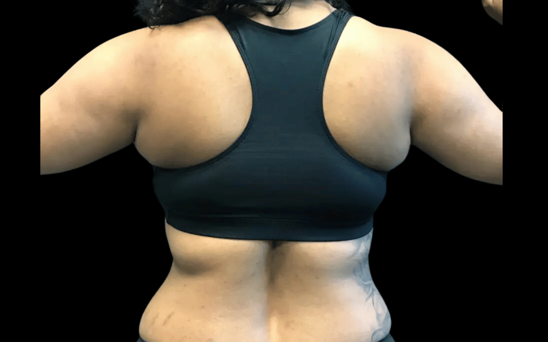 BodyTite--Case-Study-6083 | Before BodyTite