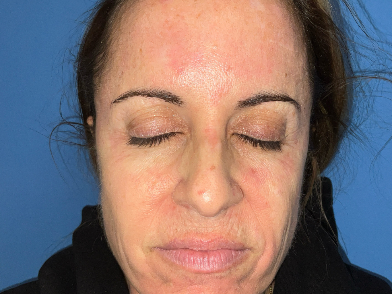 BBL--amp--MOXI-Case--31 | Before Non-surgical