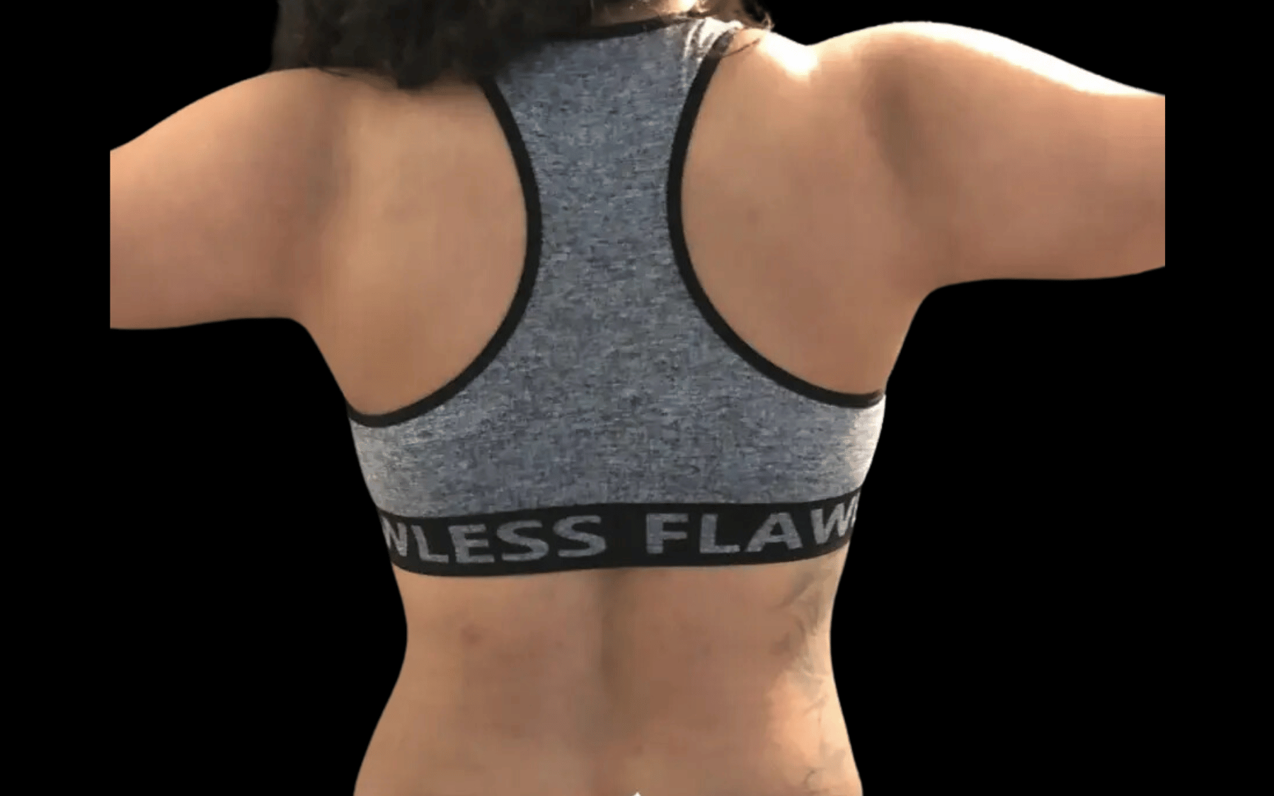 BodyTite--Case-Study-6083 | After BodyTite