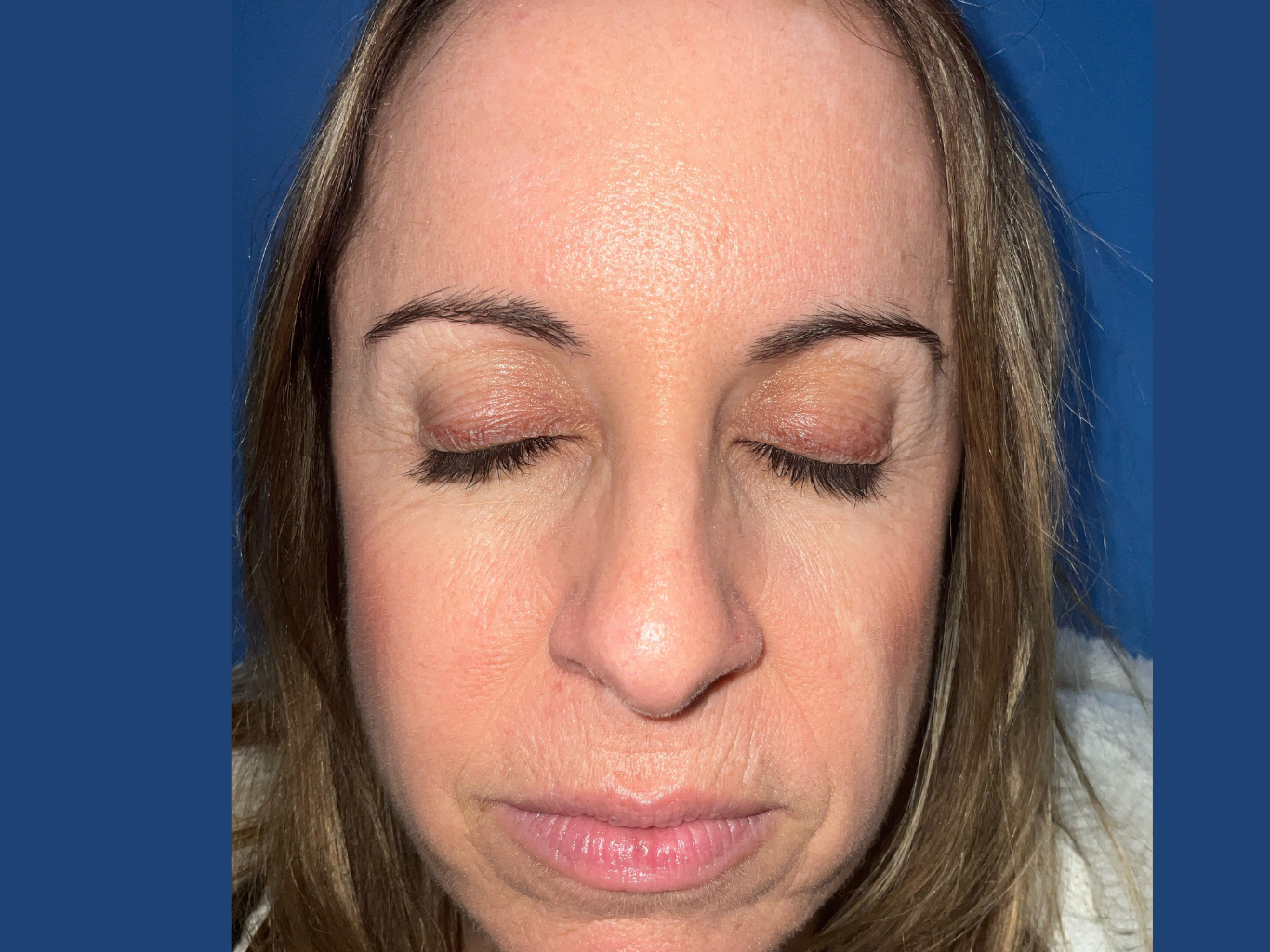 BBL--amp--MOXI-Case--31 | After Non-surgical