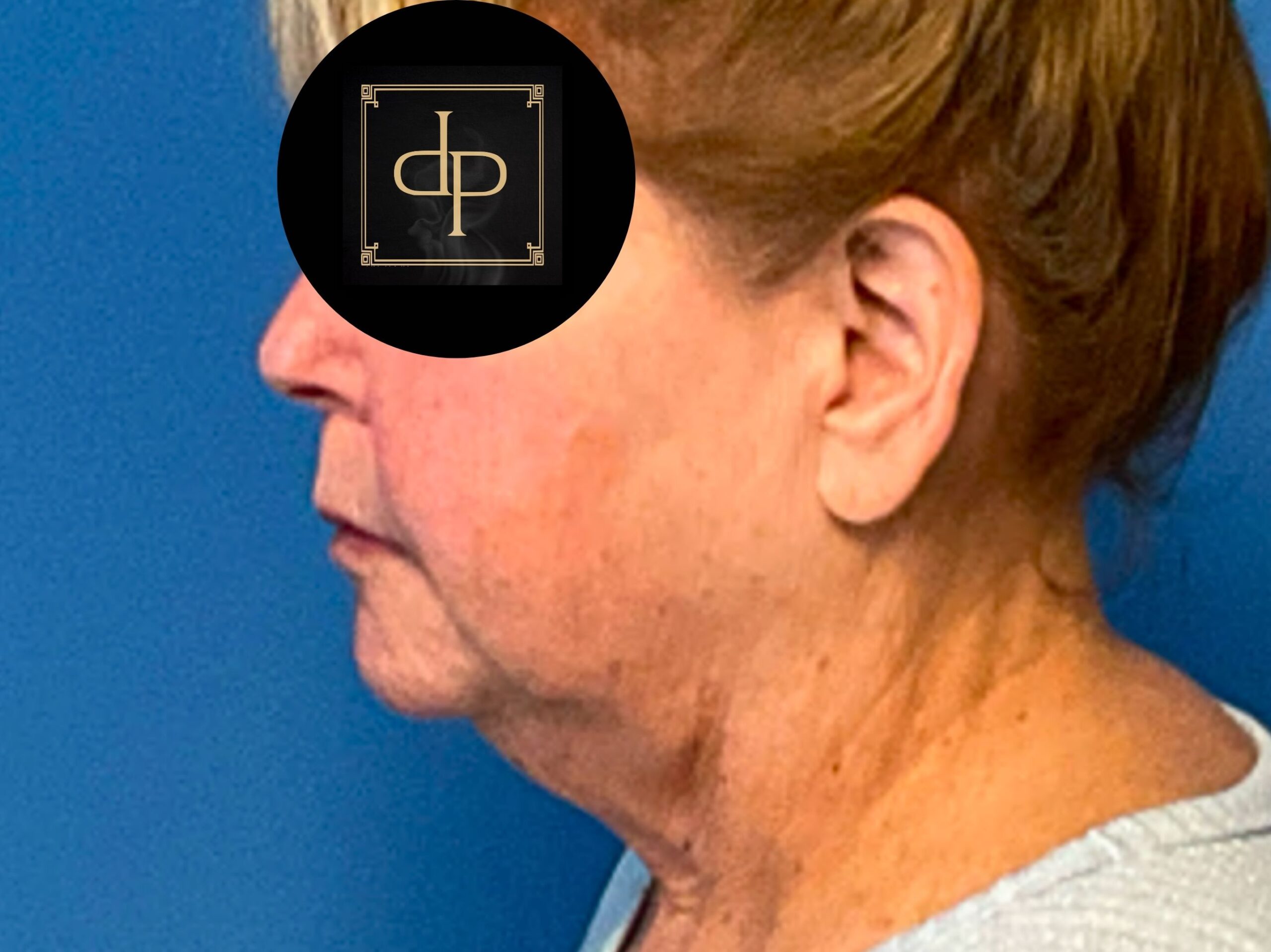 facelift-case--9596 | Before Facelift